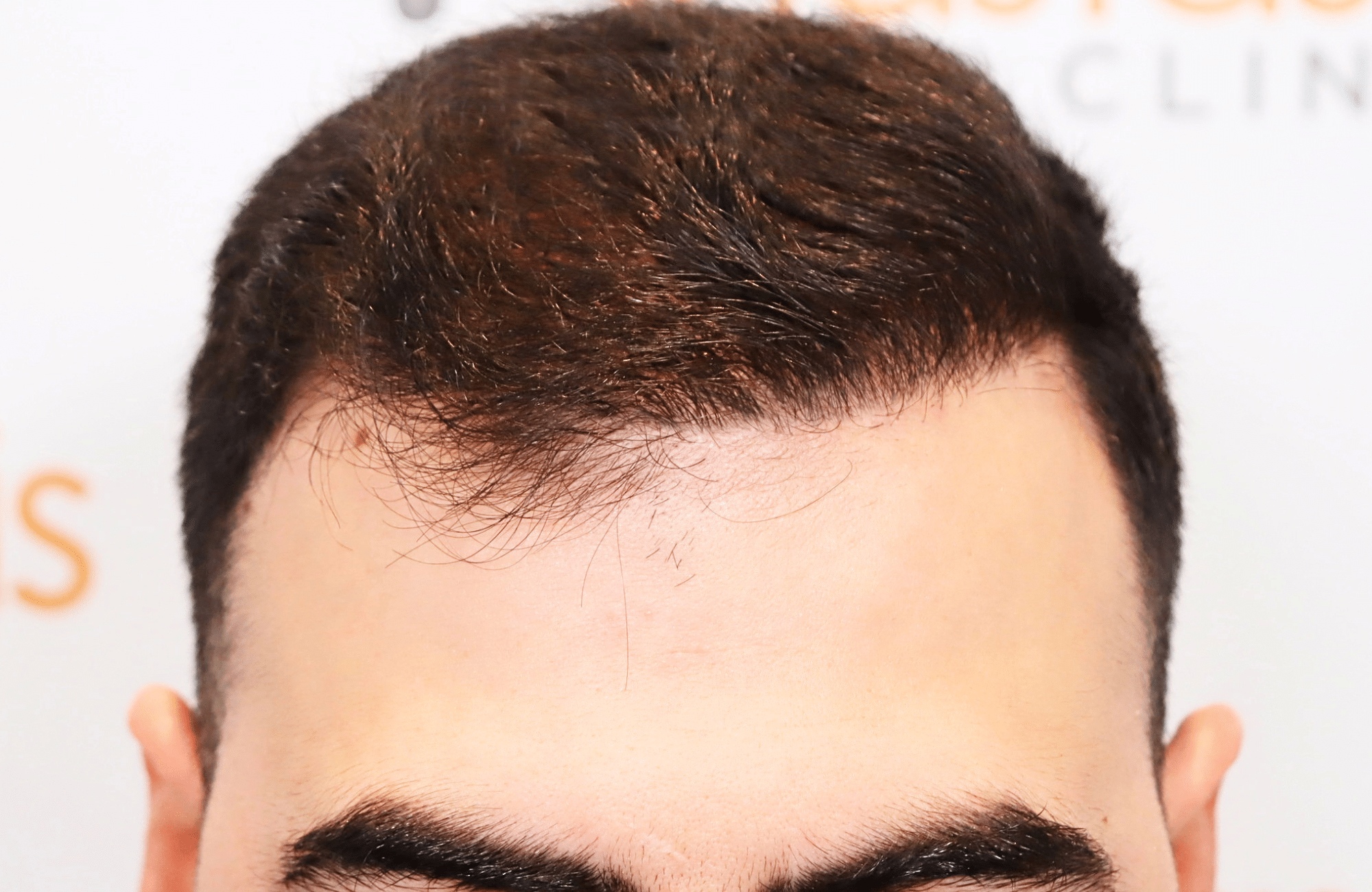 hair transplant result with 2600 fus with fue anastasakis hair clinic hairline after