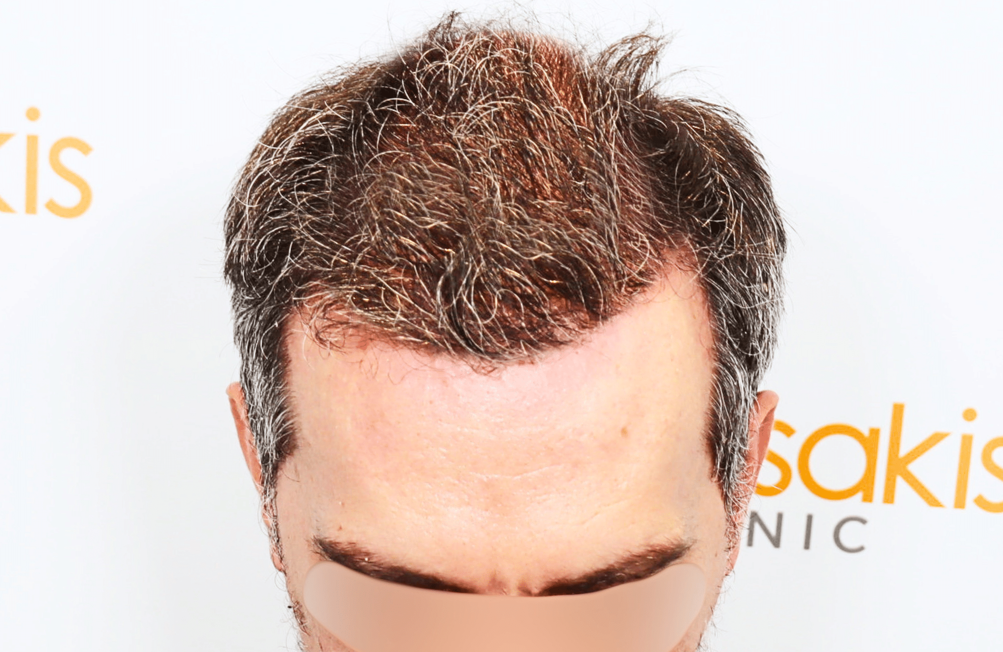 hair transplant result with 2600 fus anastasakis hair clinic frontal after