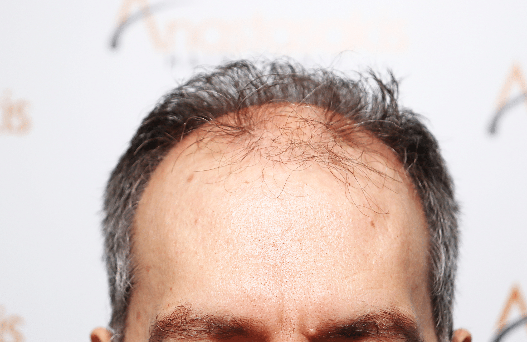 hair transplant result with 2600 fus anastasakis hair clinic hairline before