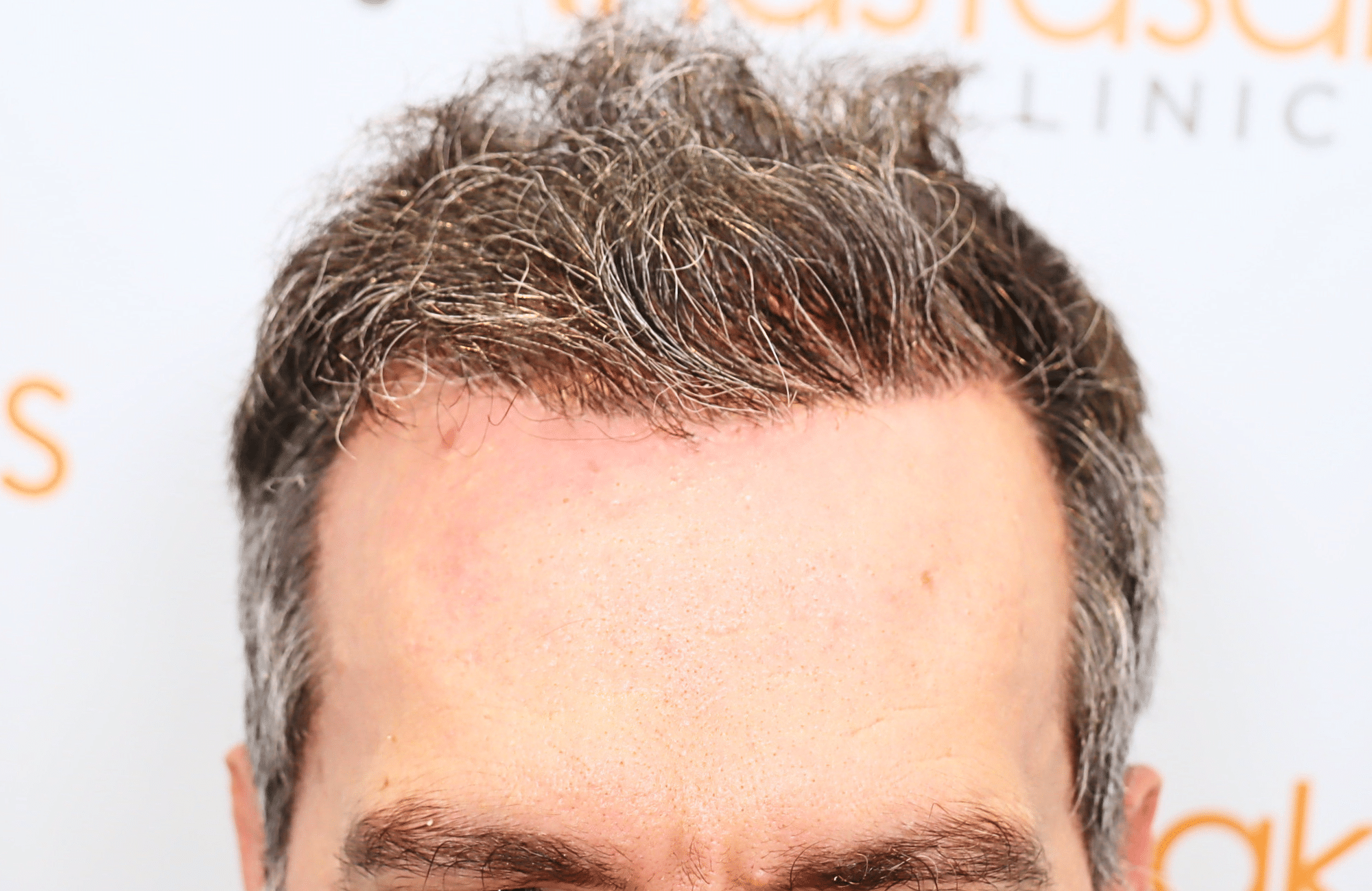 hair transplant result with 2600 fus anastasakis hair clinic hairline after