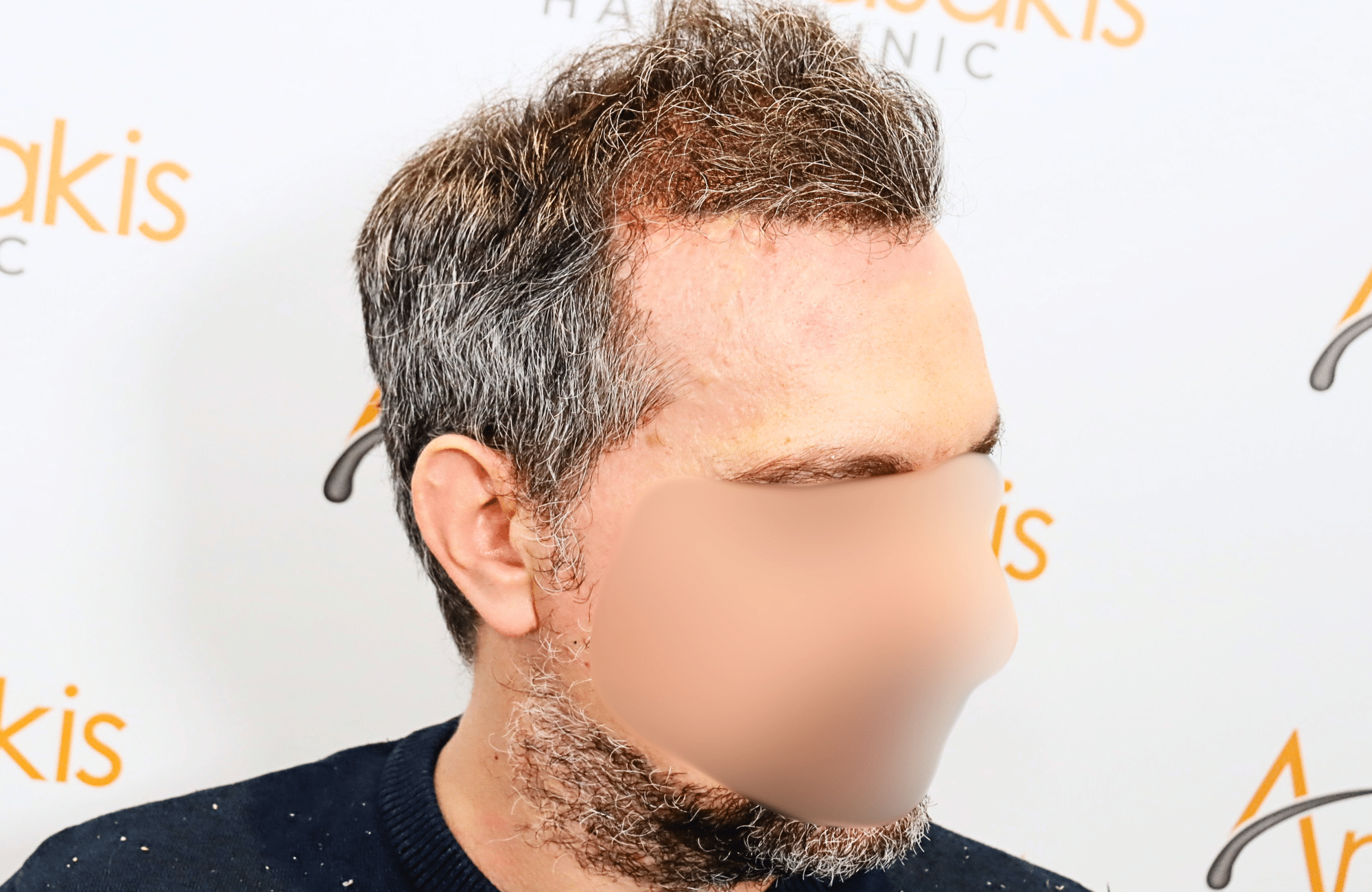 hair transplant result with 2600 fus anastasakis hair clinic side2 after