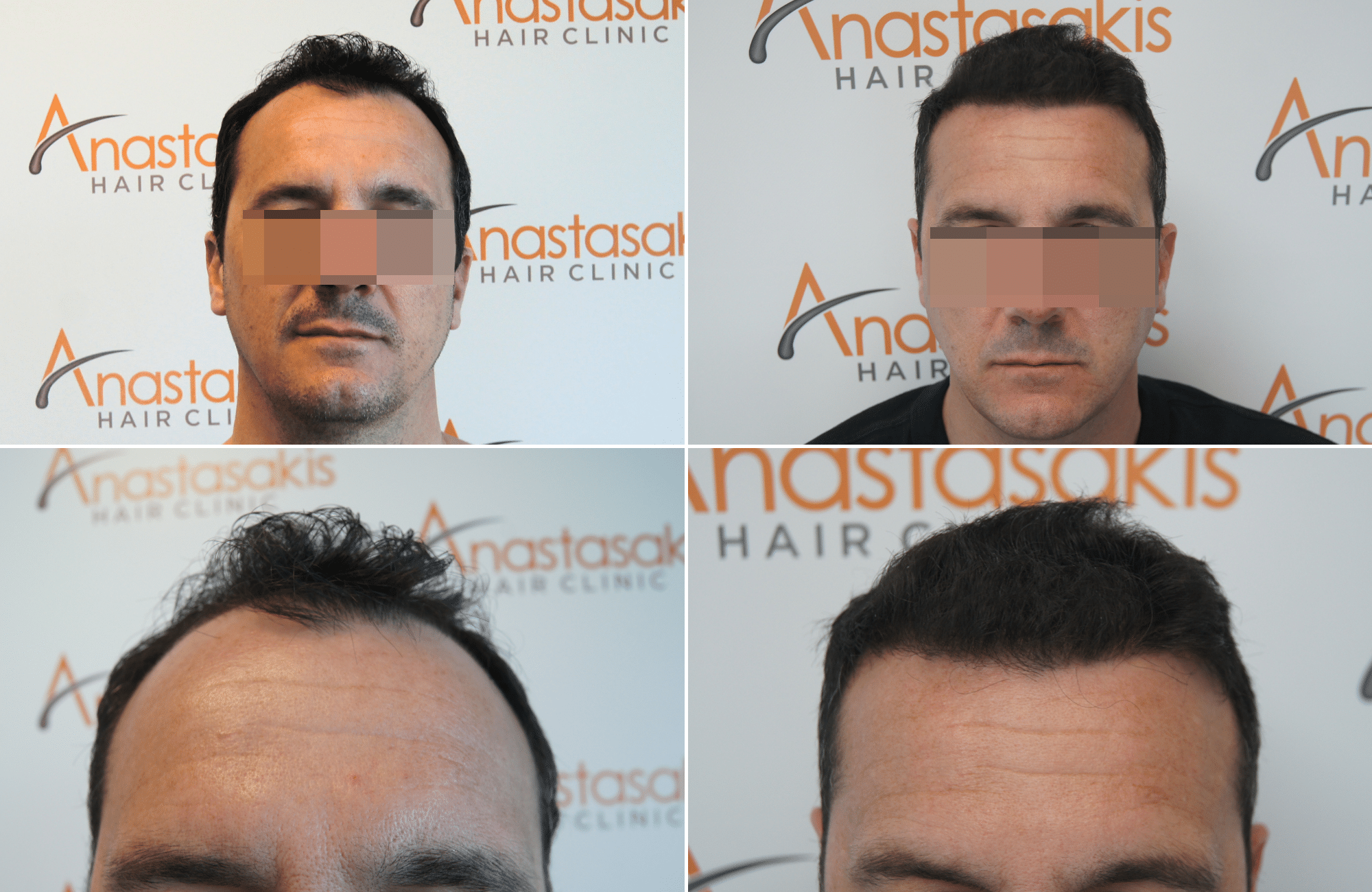 https://anastasakishairclinic.com/portfolio/apotelesma-metamosxefsis-mallion-anastasakis-hair-clinic-29/