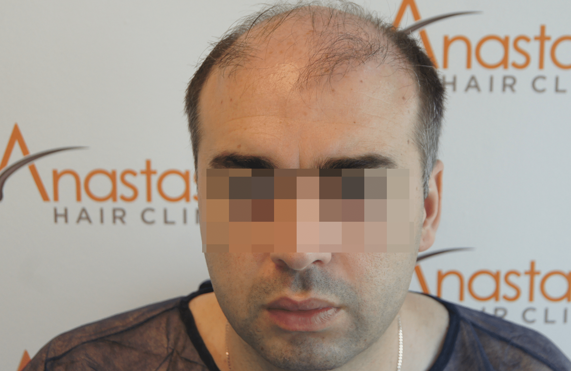 hair transplant result with 3200 follicular units anastasakis hair clinic