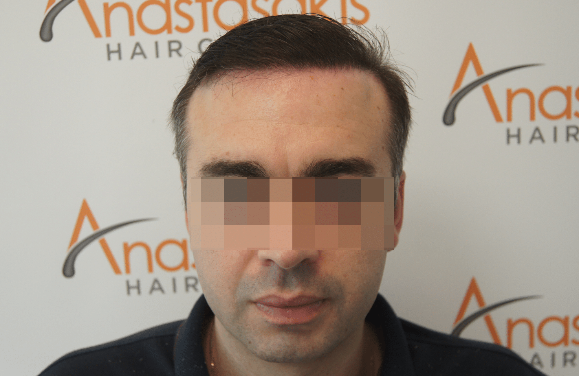 hair transplant result with 3200 follicular units anastasakis hair clinic