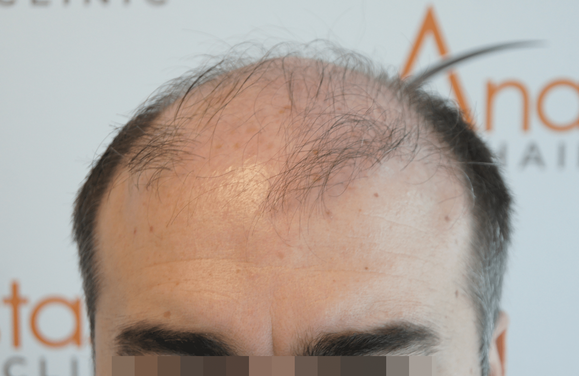 hair transplant result with 3200 follicular units anastasakis hair clinic
