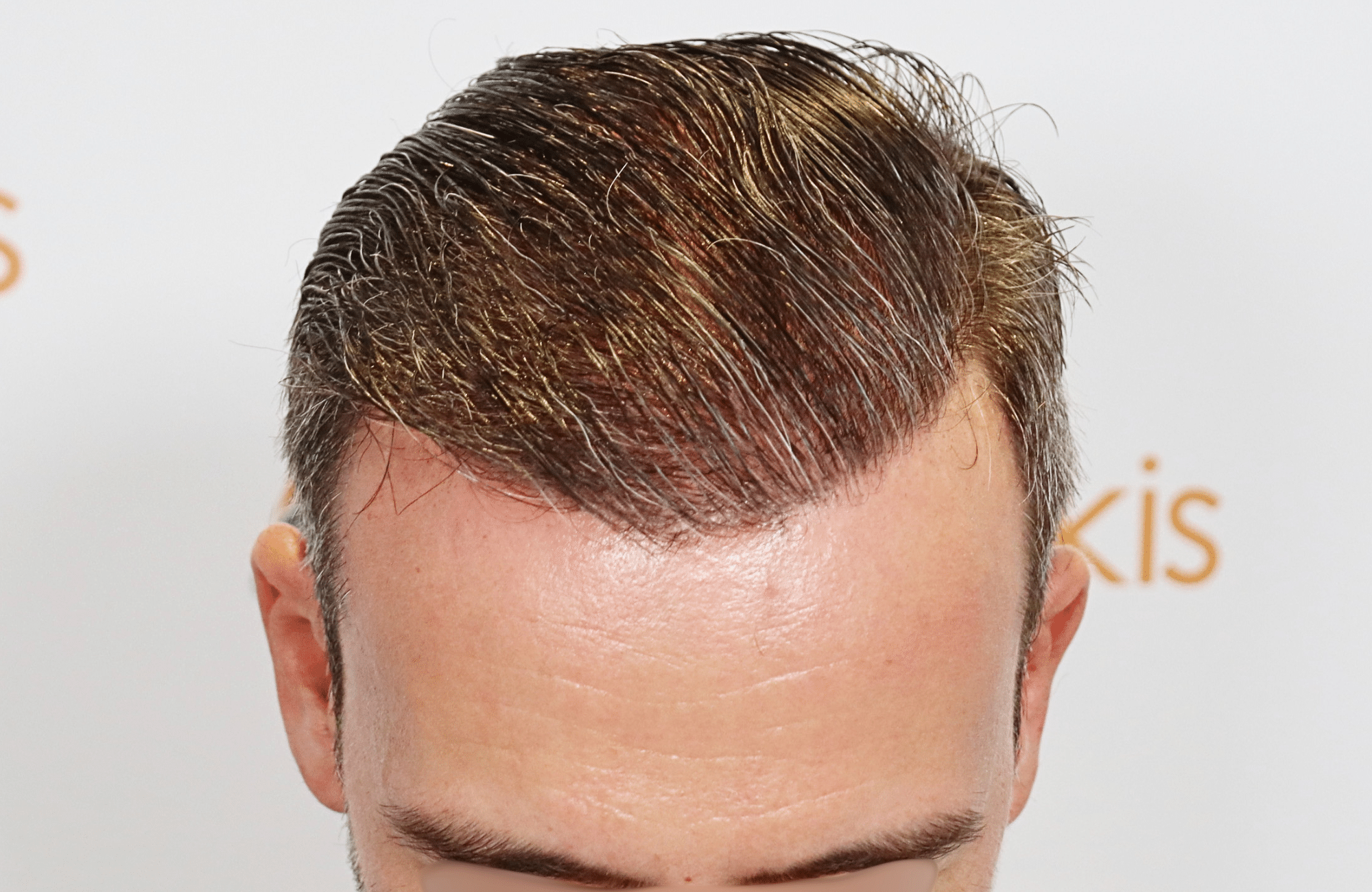 hair transplant result with 3500 grafts by anastasakis hair clinic frontal after wet hair