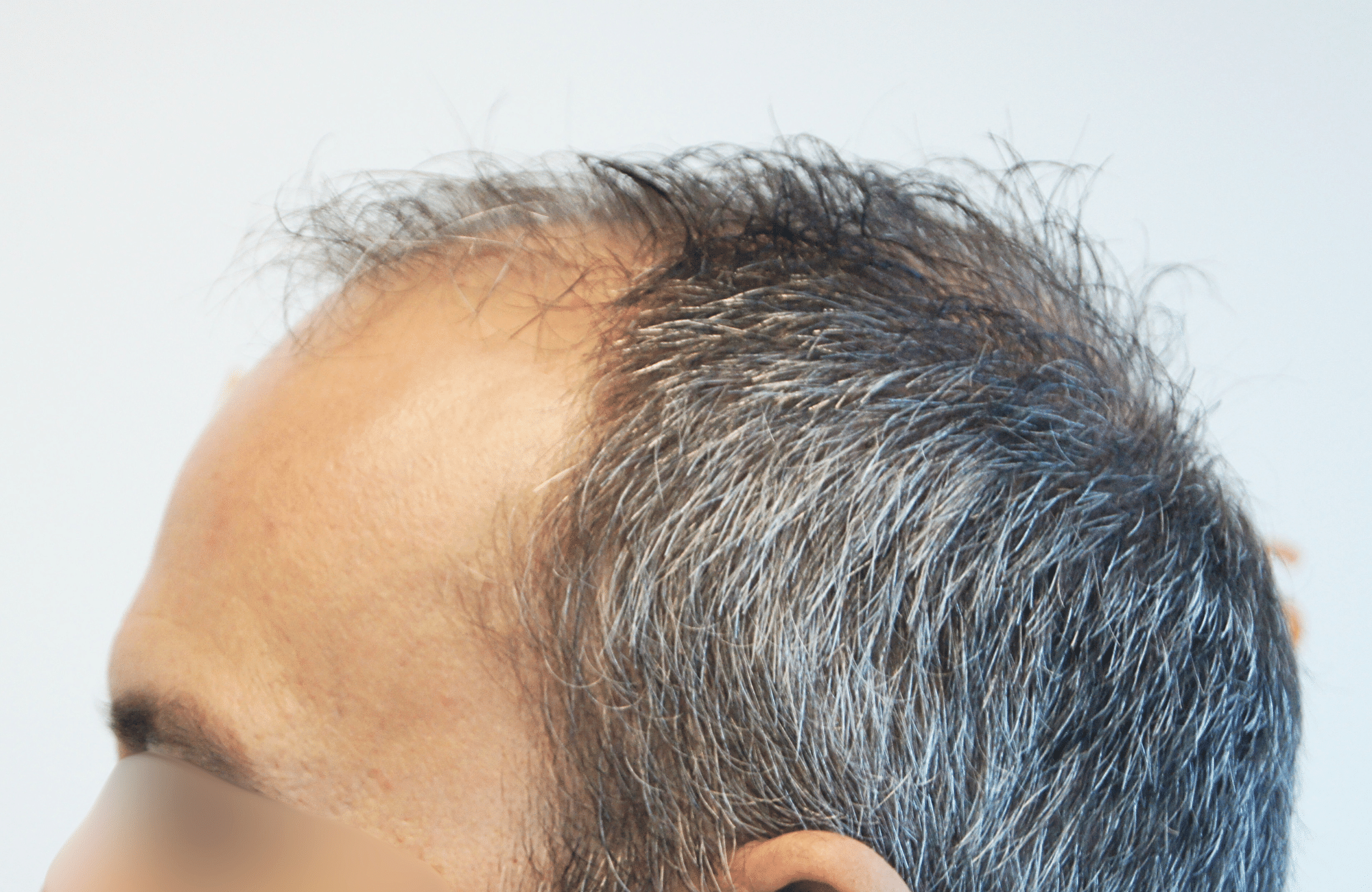 hair transplant result with 3500 grafts by anastasakis hair clinic side4 before
