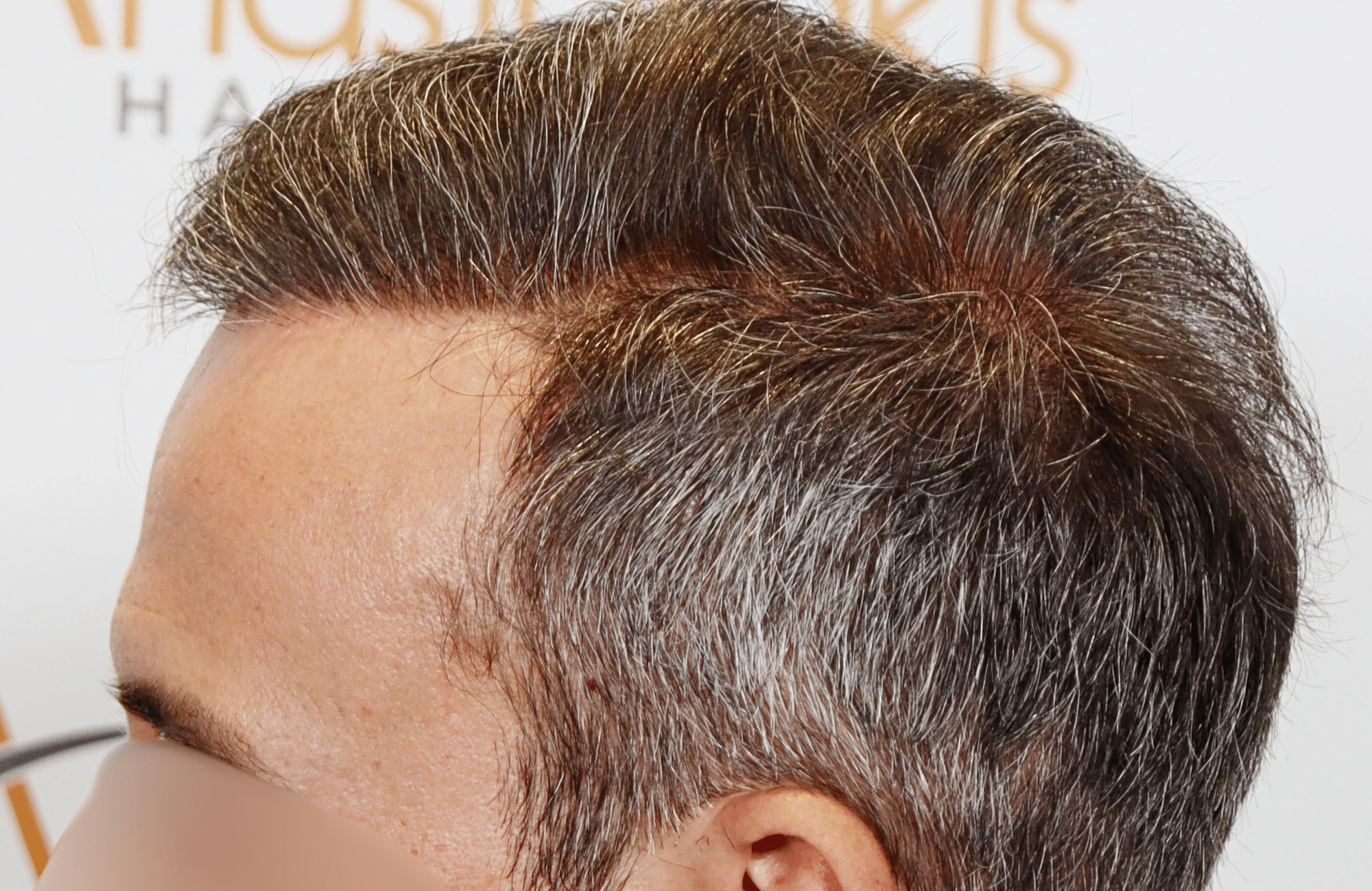hair transplant result with 3500 grafts by anastasakis hair clinic side4 after