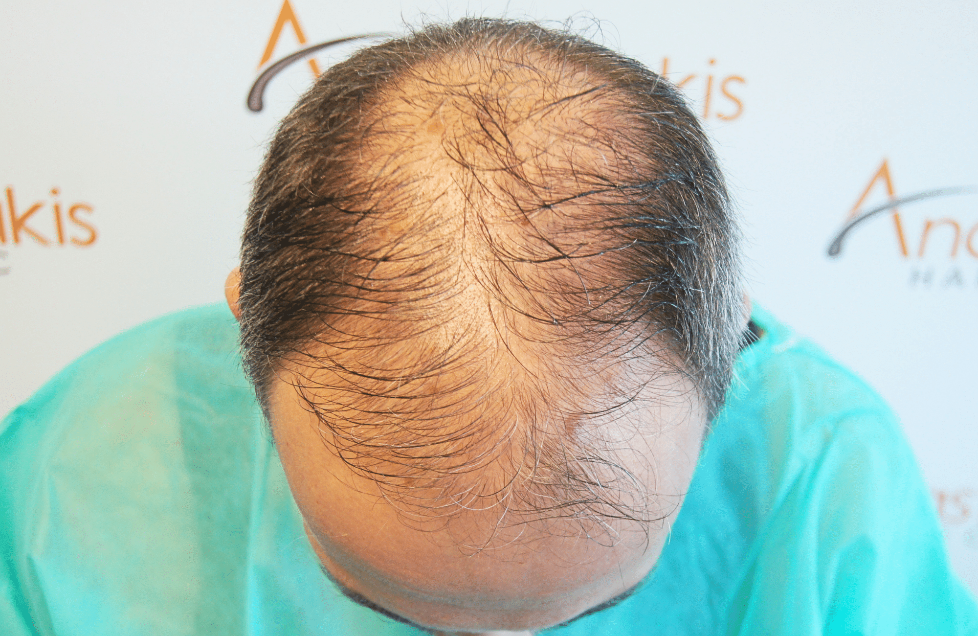 hair transplant result with 3500 grafts by anastasakis hair clinic frontal before