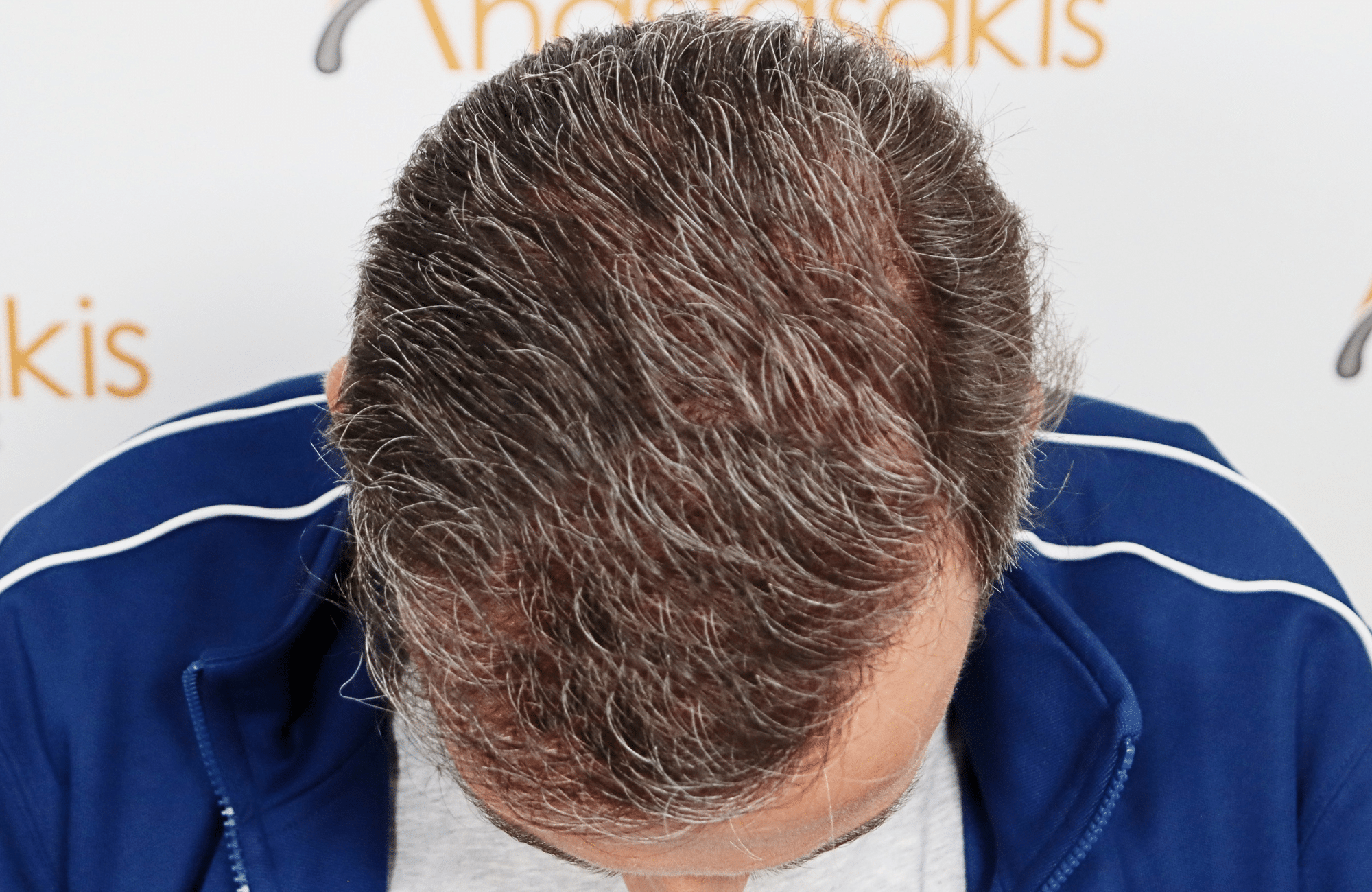 hair transplant result with 3500 grafts by anastasakis hair clinic frontal after