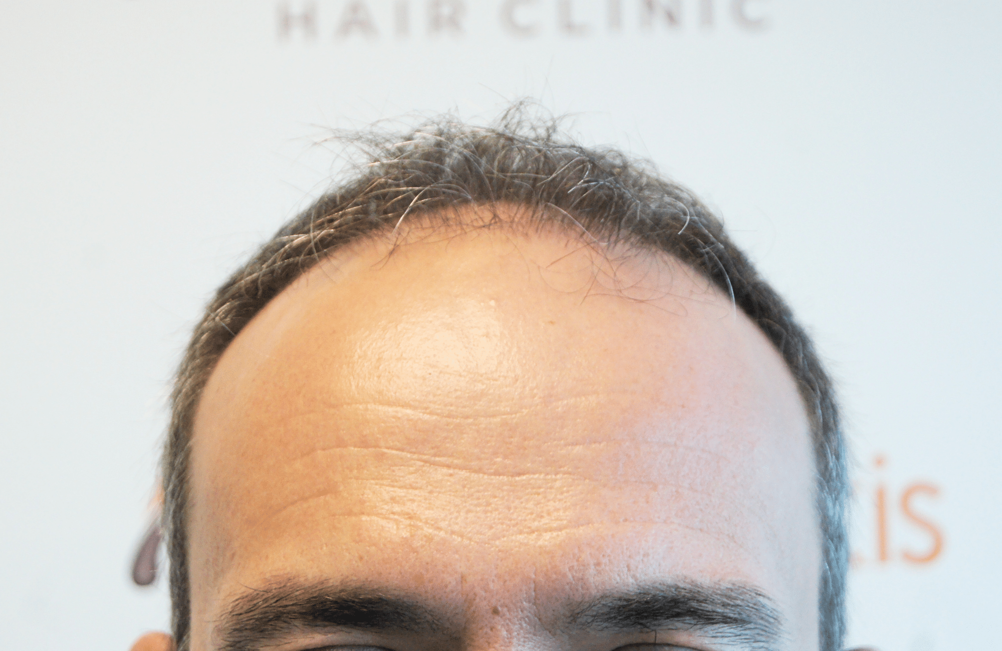 hair transplant result with 3500 grafts by anastasakis hair clinic hairline before