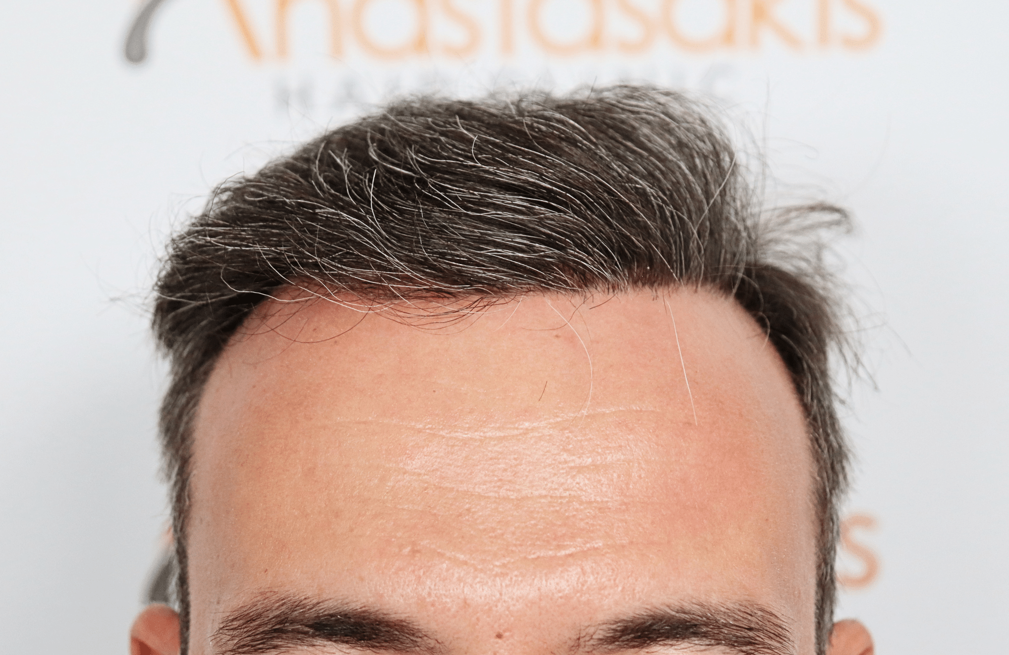 hair transplant result with 3500 grafts by anastasakis hair clinic hairline after