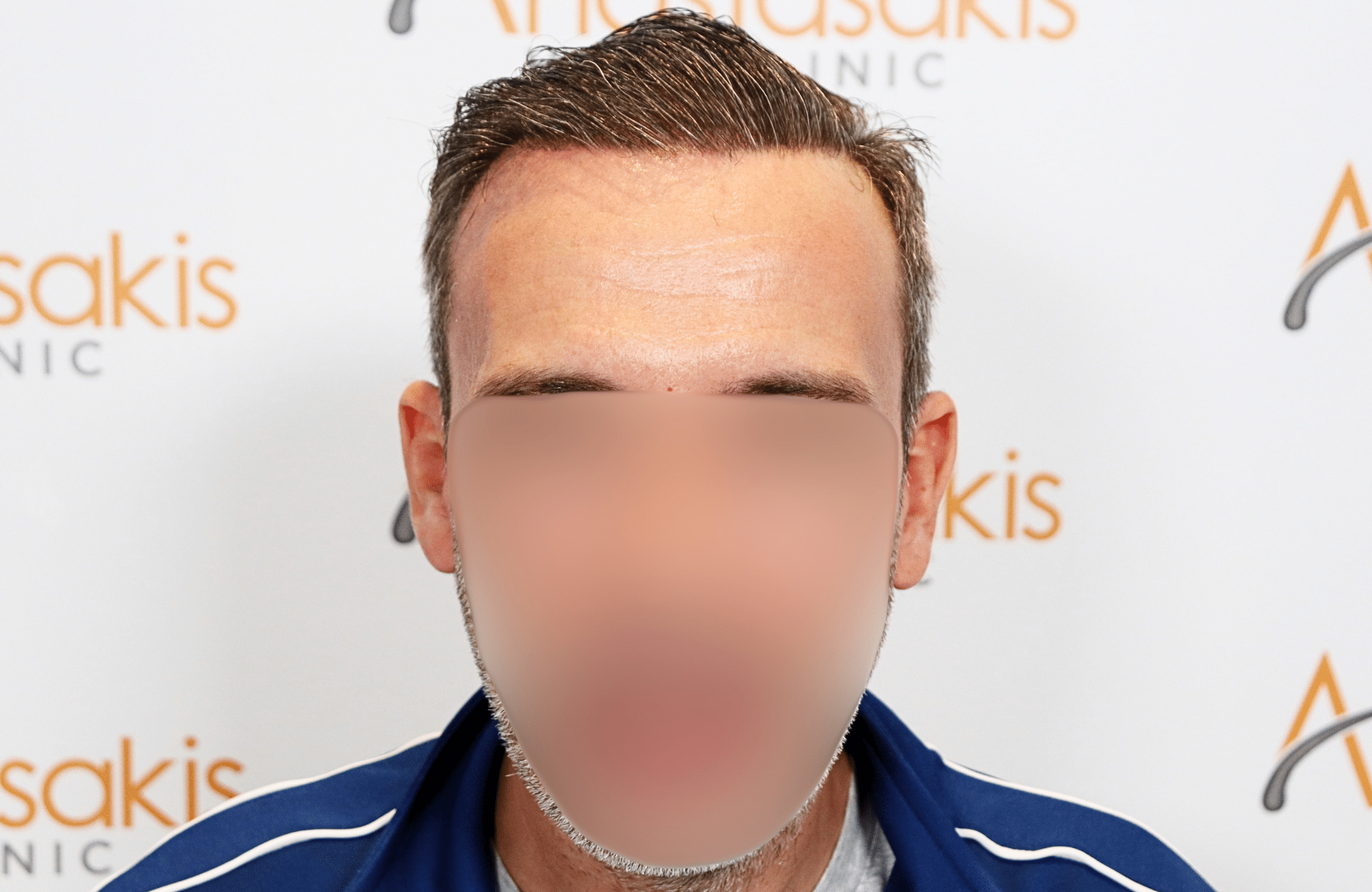 hair transplant result with 3500 grafts by anastasakis hair clinic fullface after wet hair