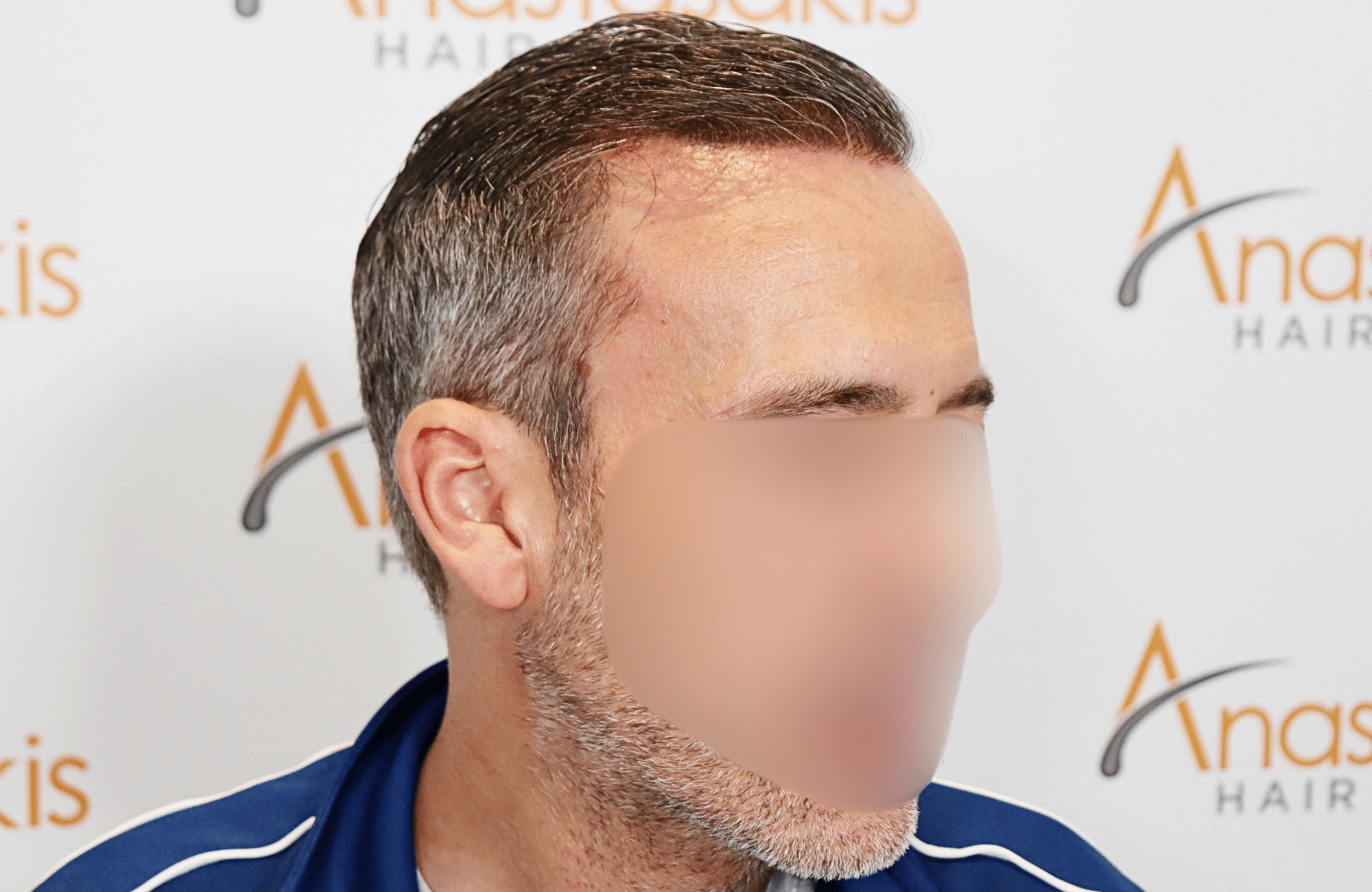 hair transplant result with 3500 grafts by anastasakis hair clinic side1 after wet hair