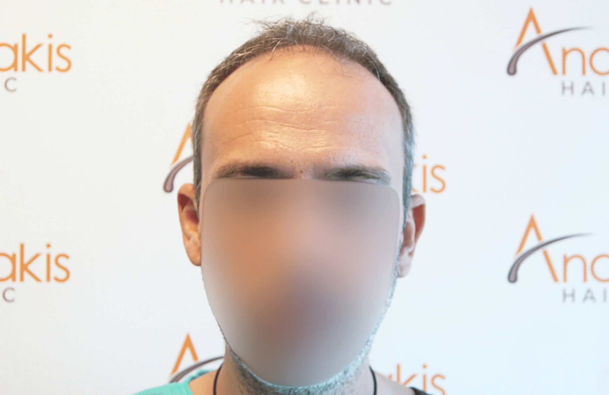 hair transplant result with 3500 grafts by anastasakis hair clinic fullface before