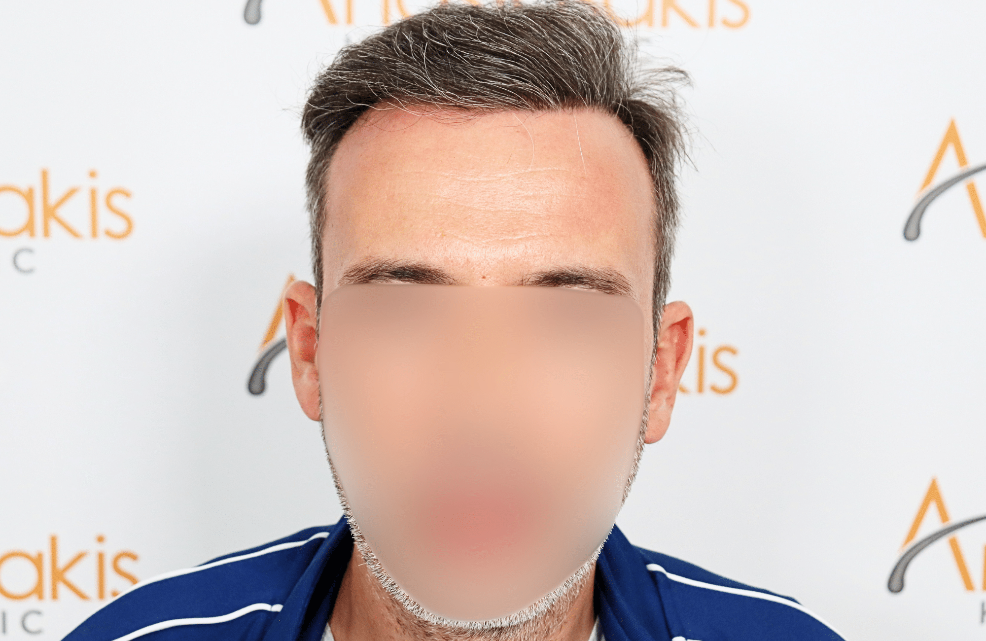 hair transplant result with 3500 grafts by anastasakis hair clinic fullface after