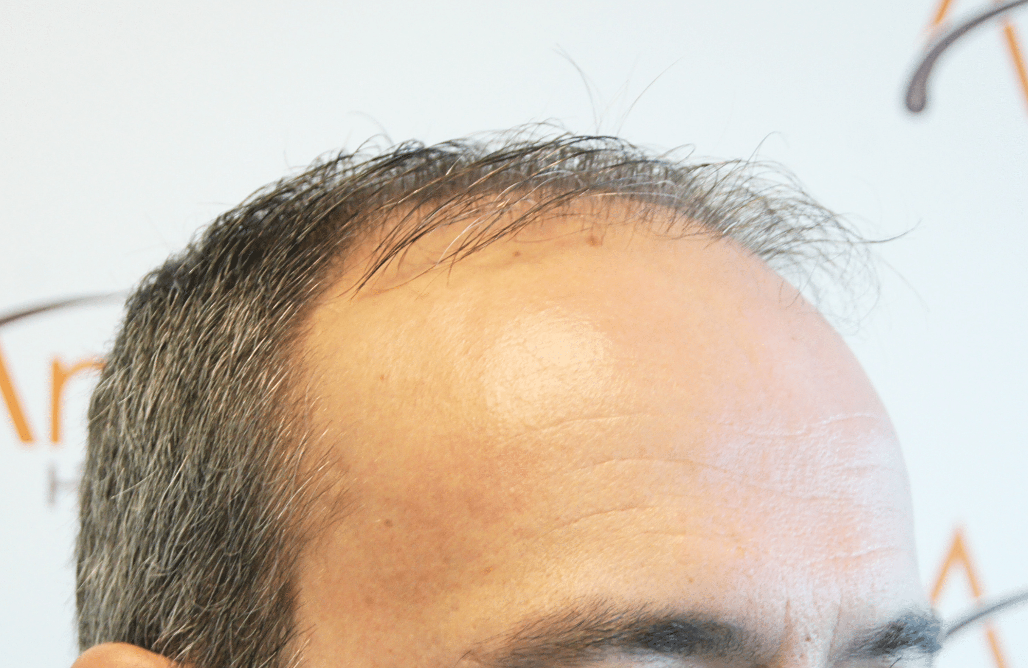 hair transplant result with 3500 grafts by anastasakis hair clinic side1 before