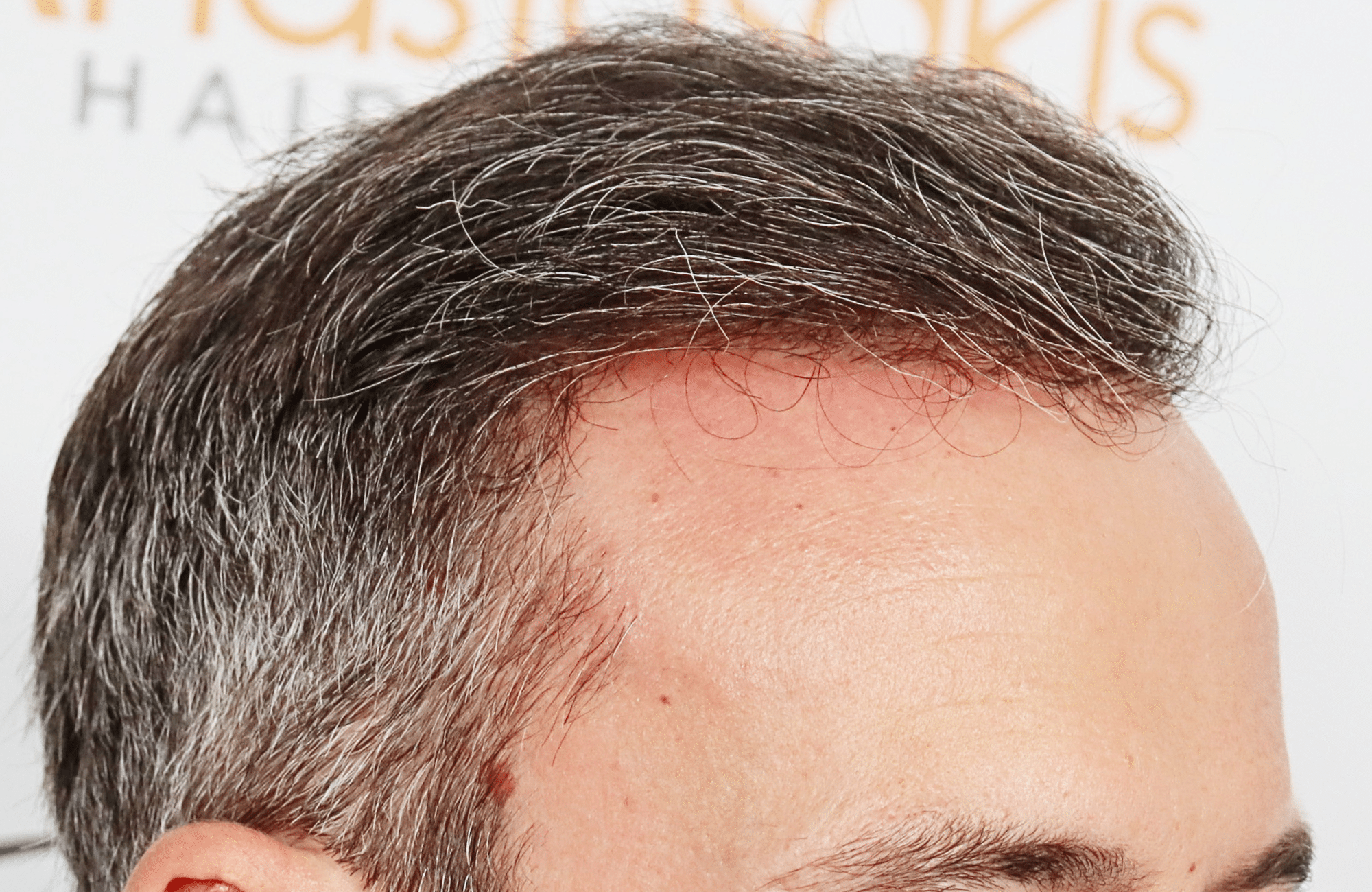 hair transplant result with 3500 grafts by anastasakis hair clinic side1 after