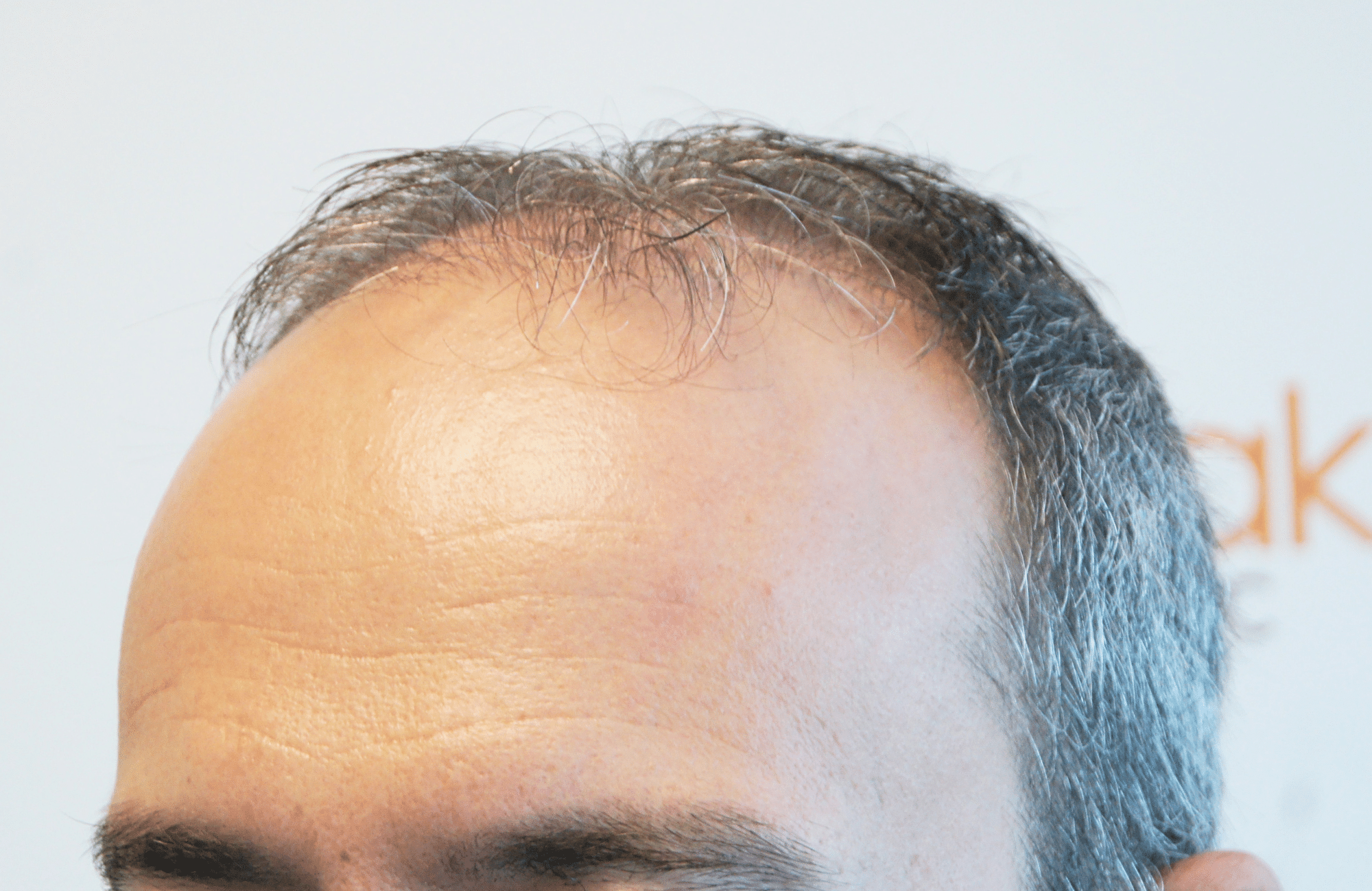 hair transplant result with 3500 grafts by anastasakis hair clinic side2 before