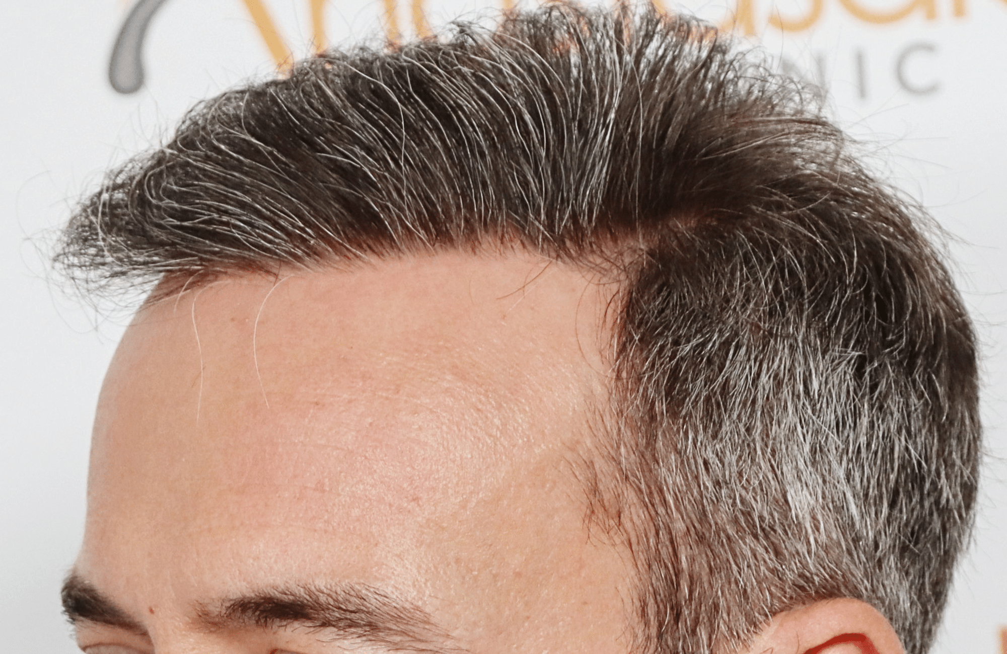hair transplant result with 3500 grafts by anastasakis hair clinic side2 after