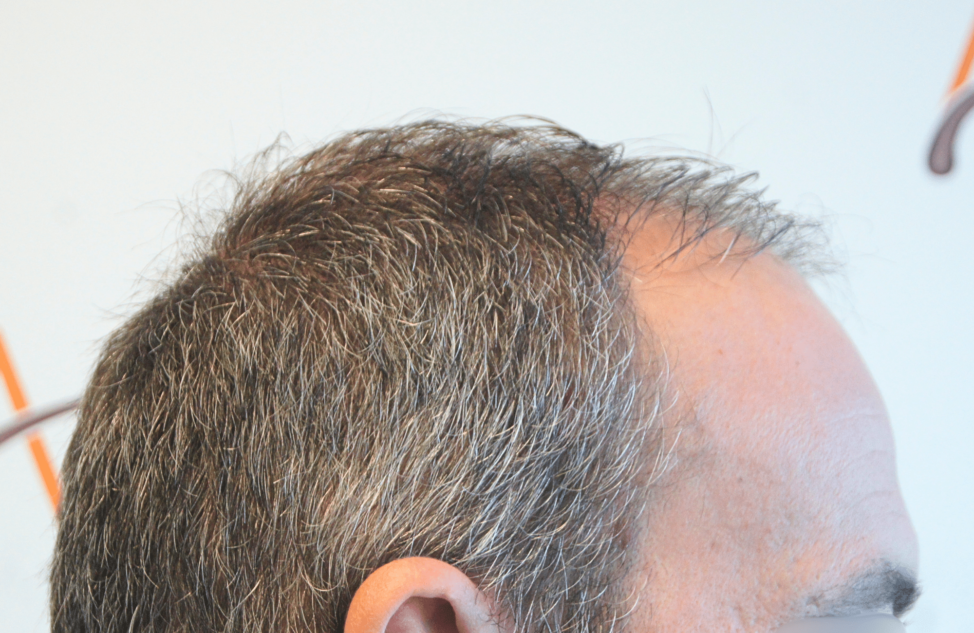 hair transplant result with 3500 grafts by anastasakis hair clinic side3 before