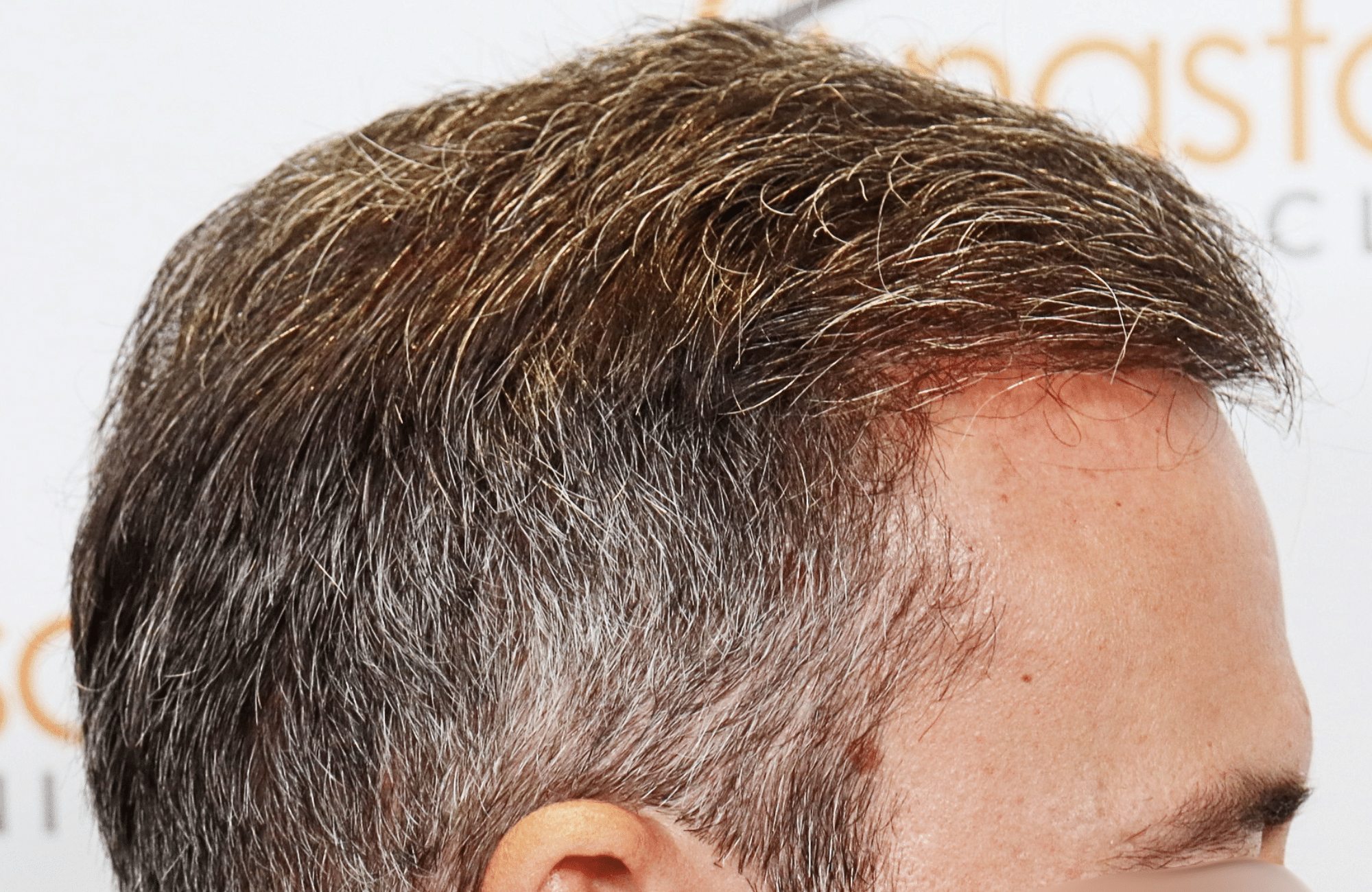 hair transplant result with 3500 grafts by anastasakis hair clinic side3 after
