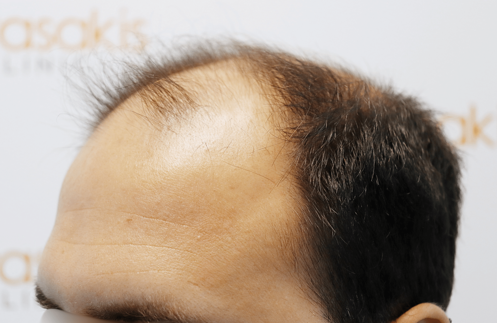 hair transplant result in 30-year-old man with 3500 fus anastasakis hair clinic side1 before