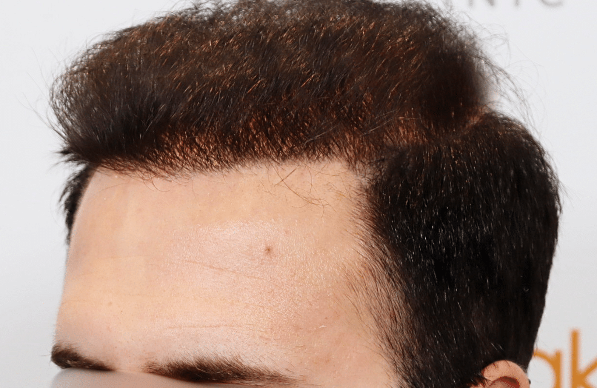 hair transplant result in 30-year-old man with 3500 fus anastasakis hair clinic side1 after