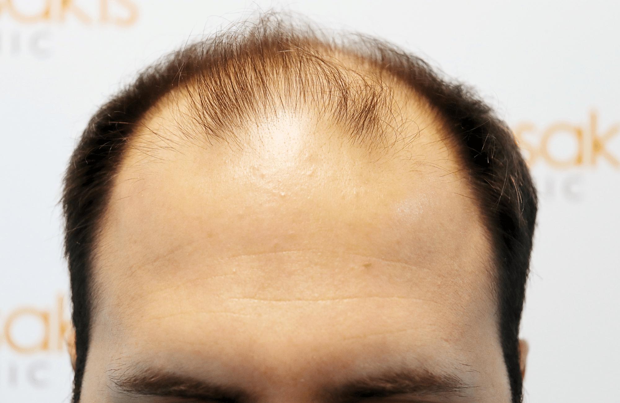hair transplant result in 30-year-old man with 3500 fus anastasakis hair clinic hairline before