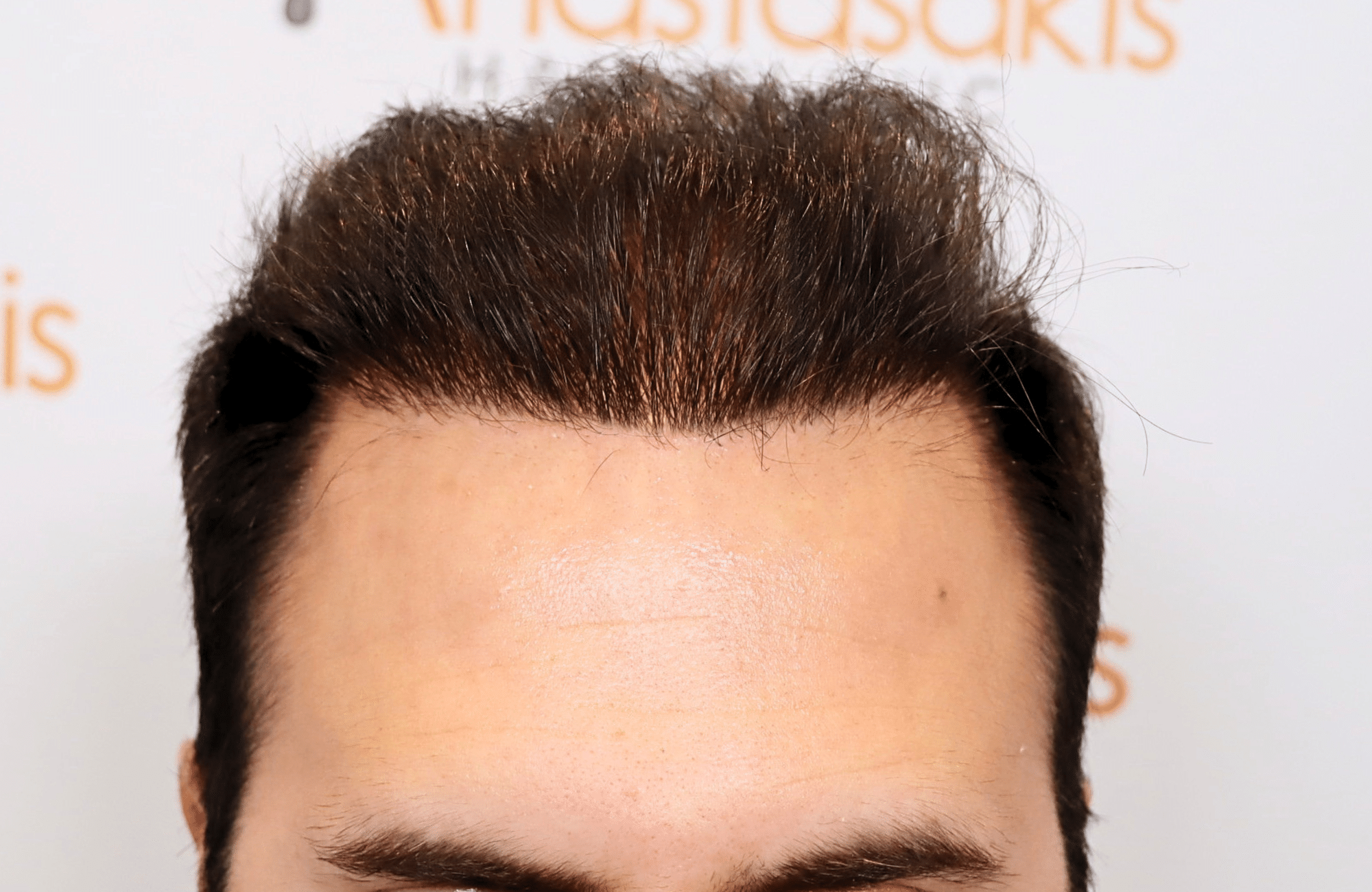 hair transplant result in 30-year-old man with 3500 fus anastasakis hair clinic hairline after