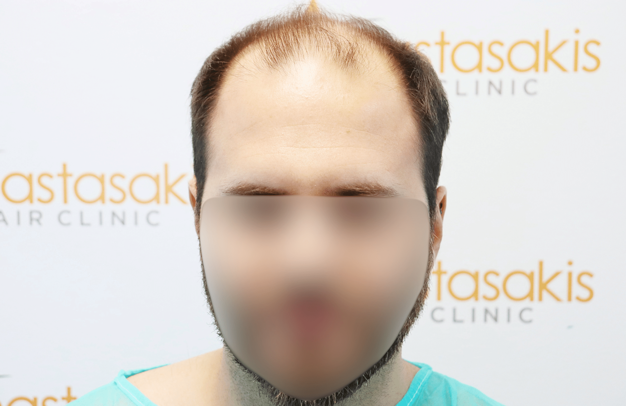 hair transplant result in 30-year-old man with 3500 fus anastasakis hair clinic fullface before