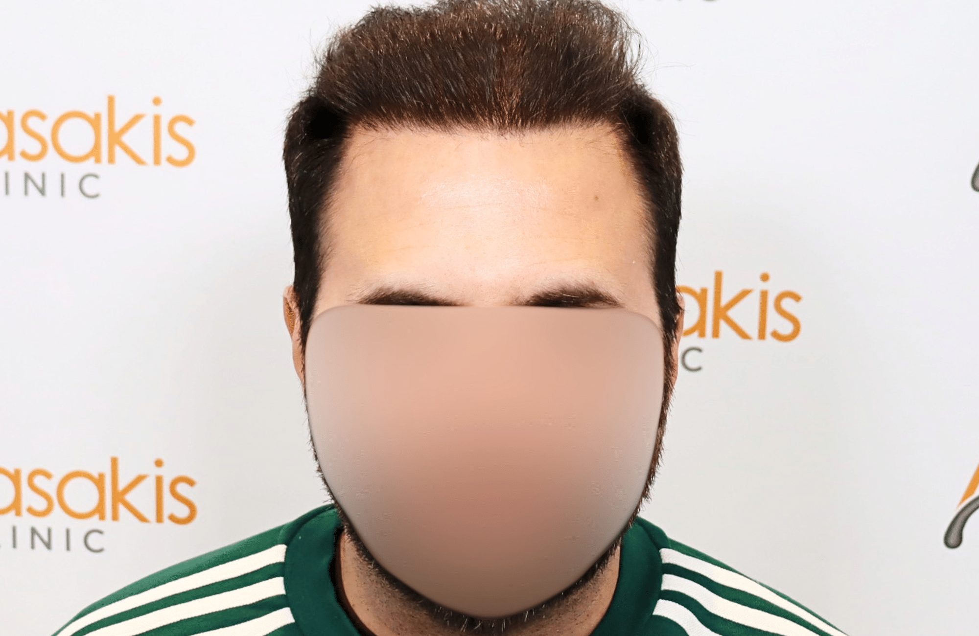 hair transplant result in 30-year-old man with 3500 fus anastasakis hair clinic fullface after