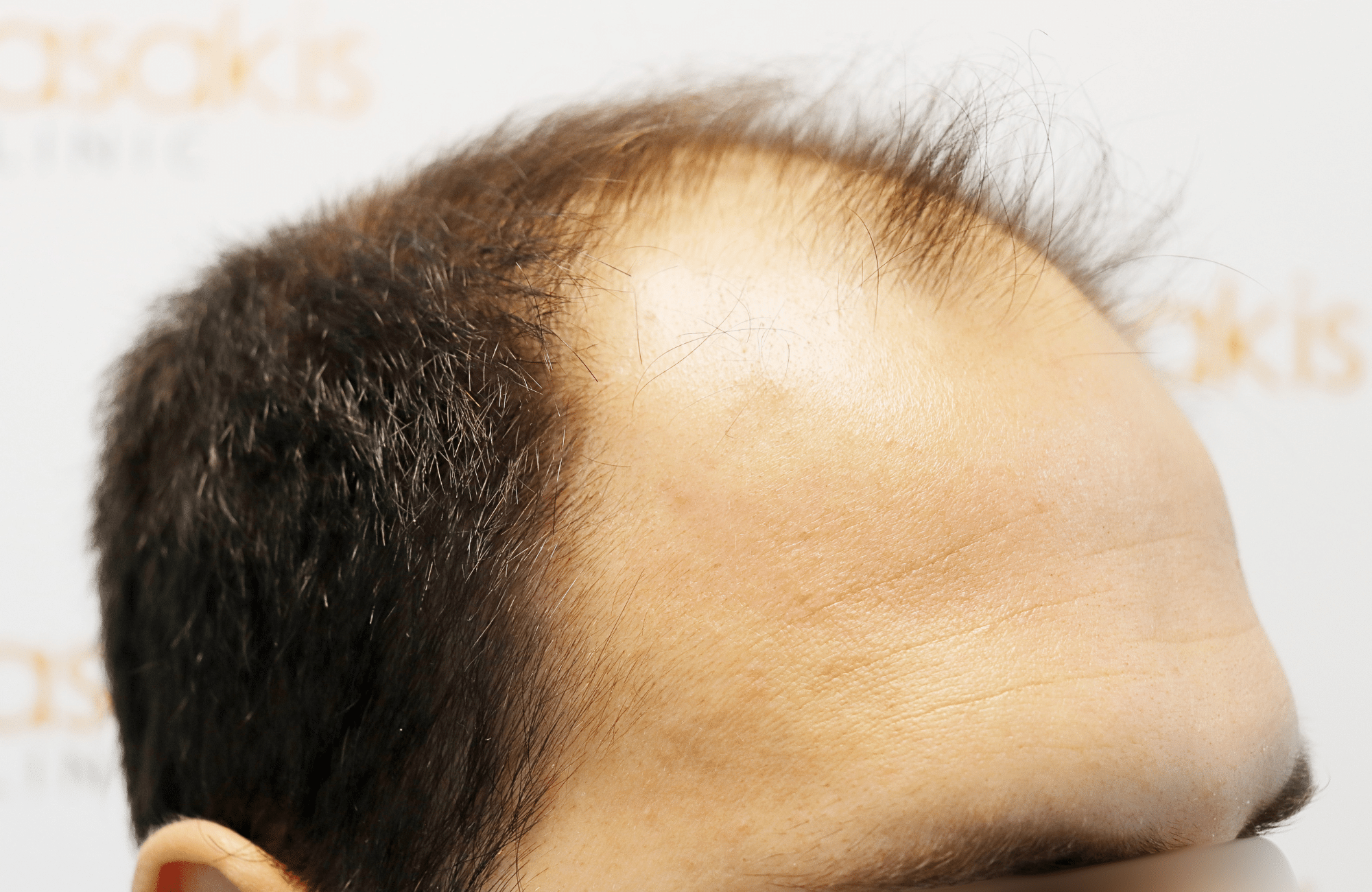 hair transplant result in 30-year-old man with 3500 fus anastasakis hair clinic side2 before