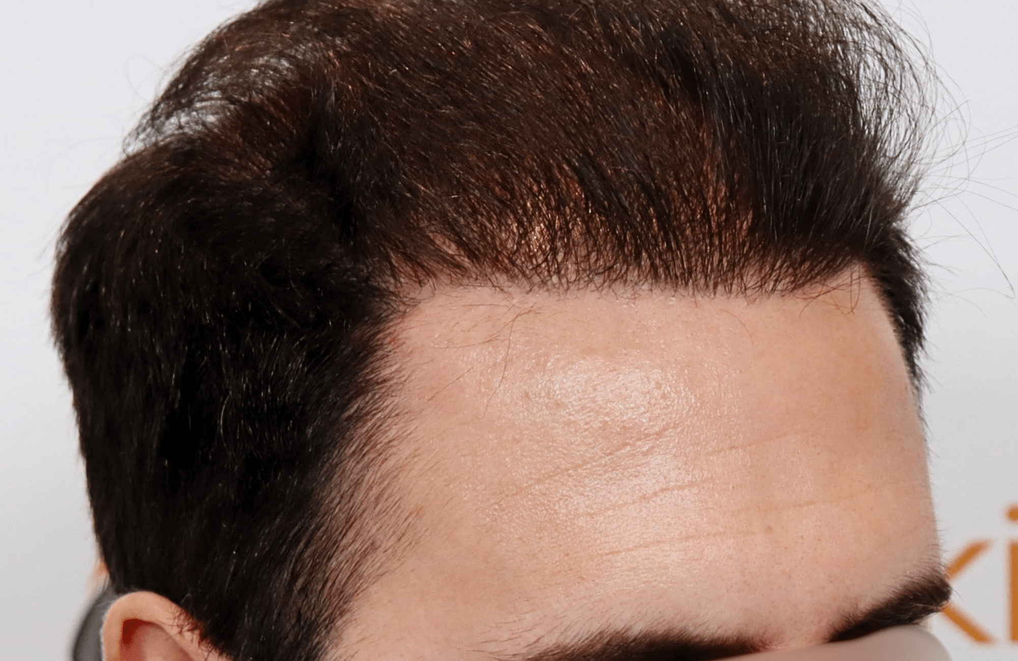 hair transplant result in 30-year-old man with 3500 fus anastasakis hair clinic side2 after