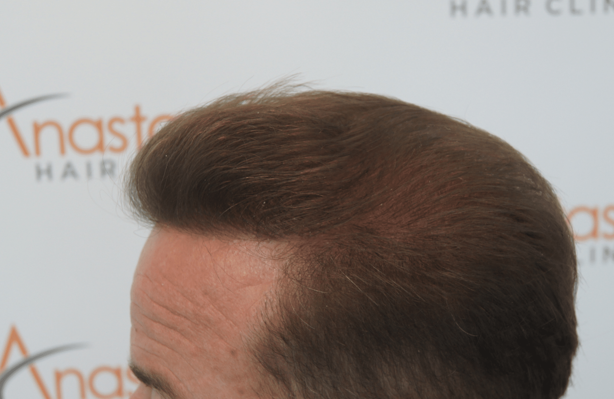 hair transplant with 2600 fus fue after - side2