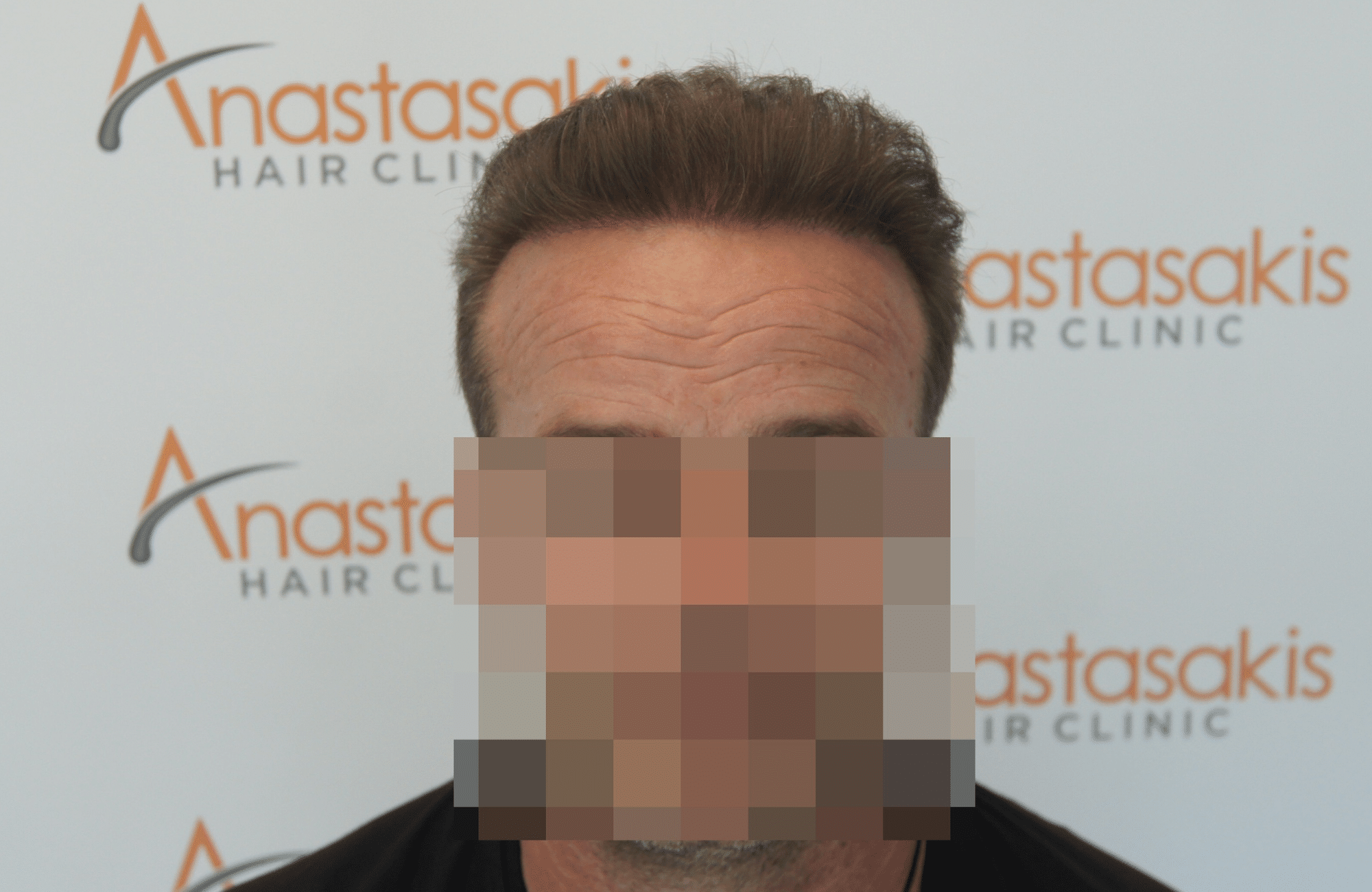 hair transplant with 2600 fus fue after - fullface