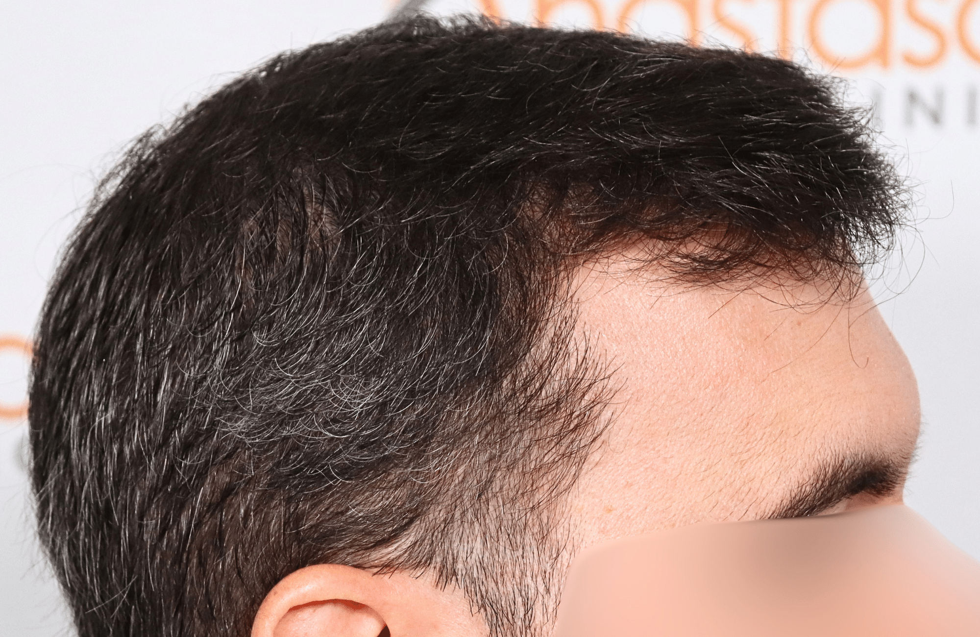 hair transplat result 40yo thick