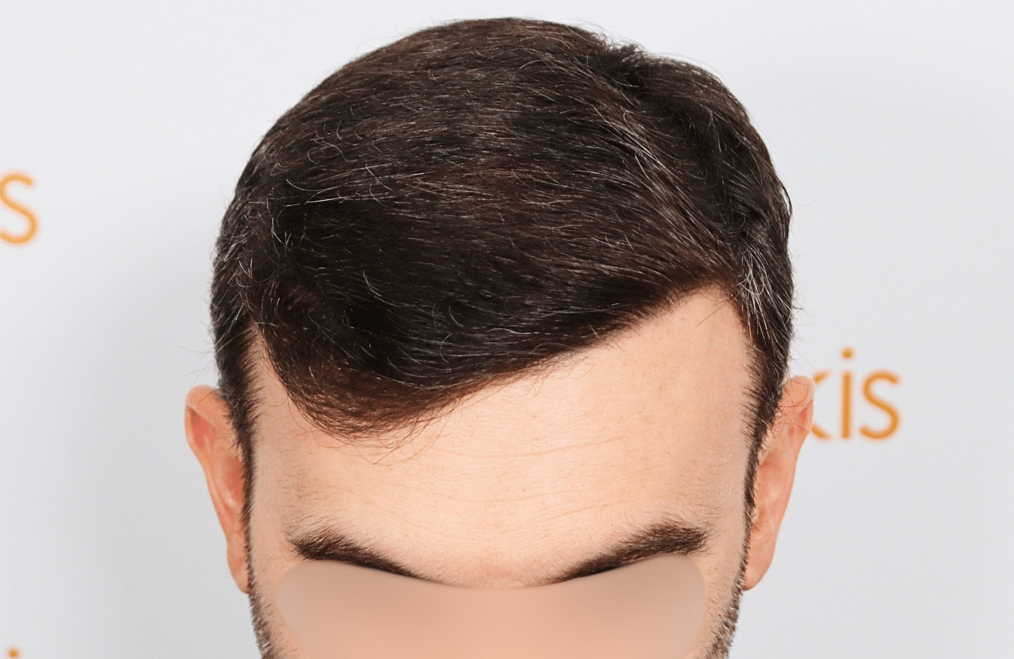 hair transplat result 40yo thick