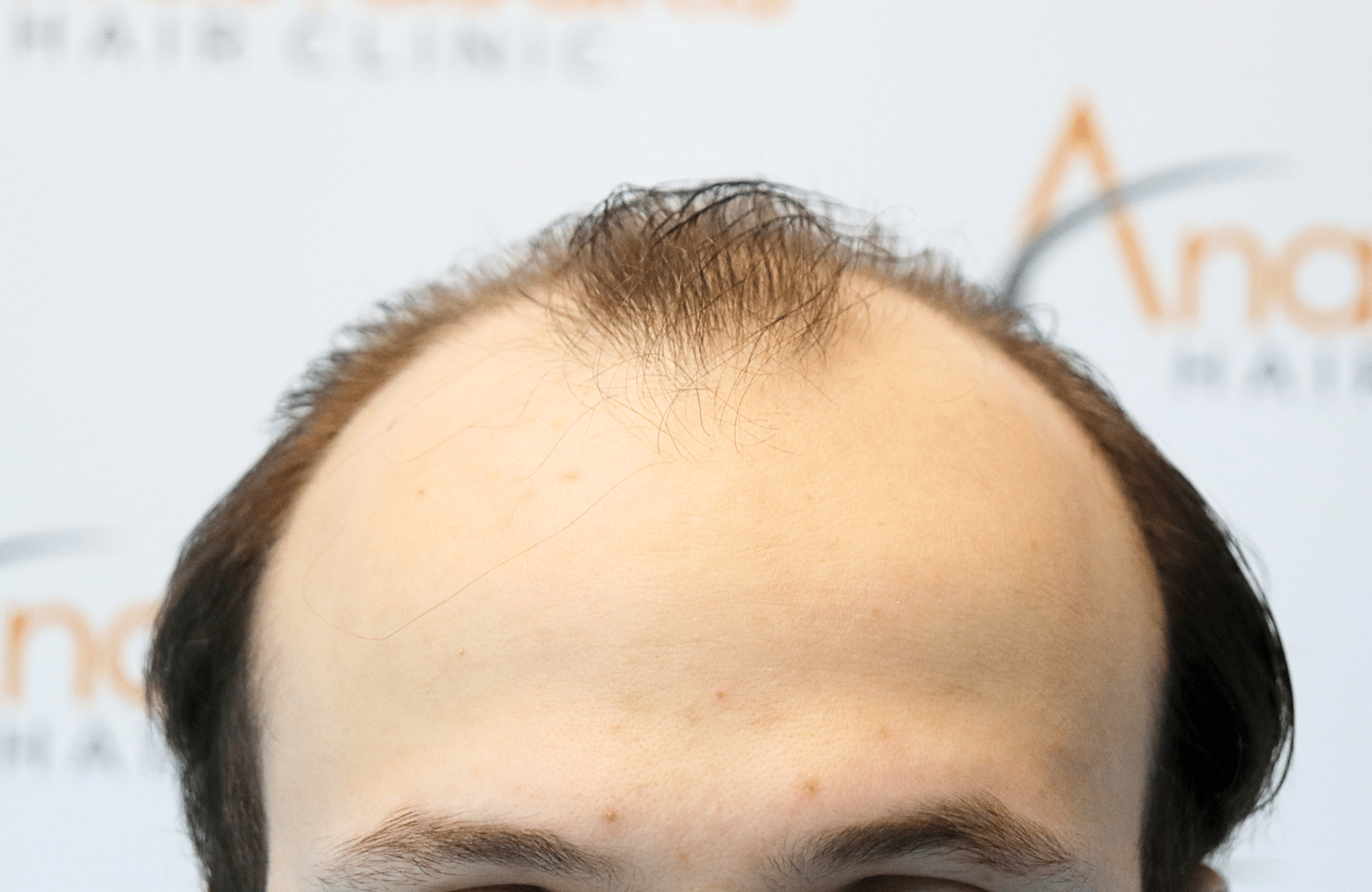 hair trensplant result 3500 fus 30 yr frontal