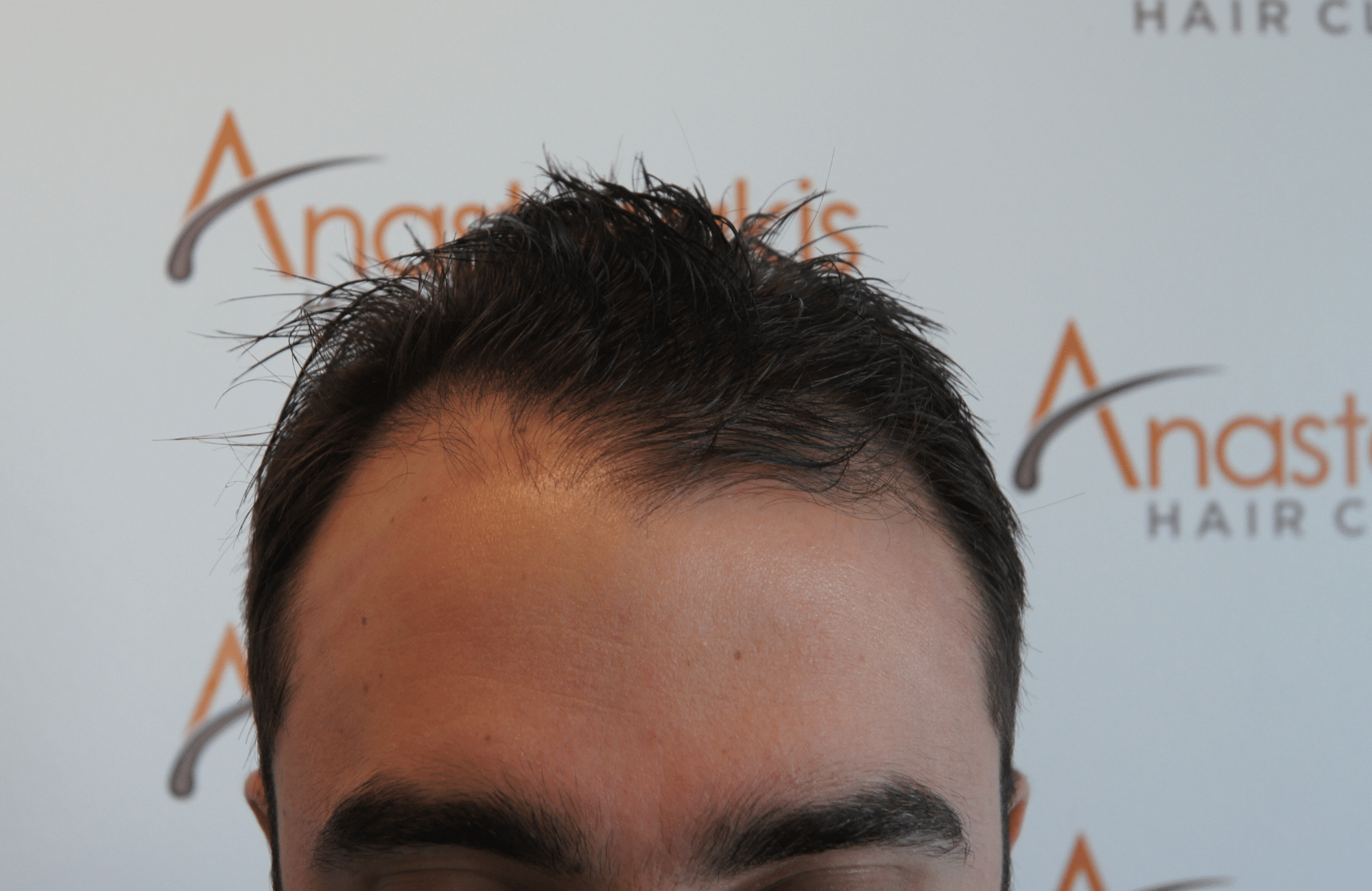 peristatiko prin ti metamosxefsi mallion me 2200 fus hairline