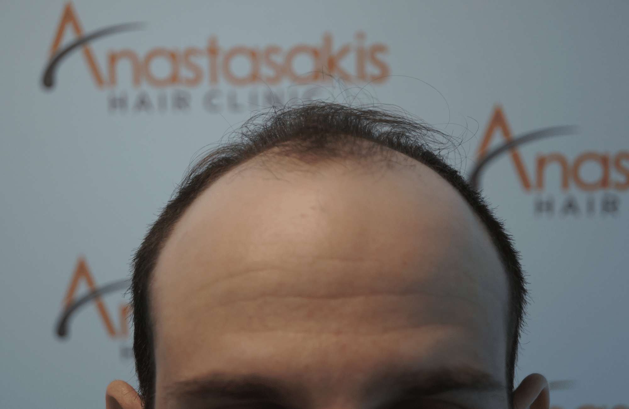 peristatiko piknosis prin ti metamosxefsi mallion me 2500 fus hairline