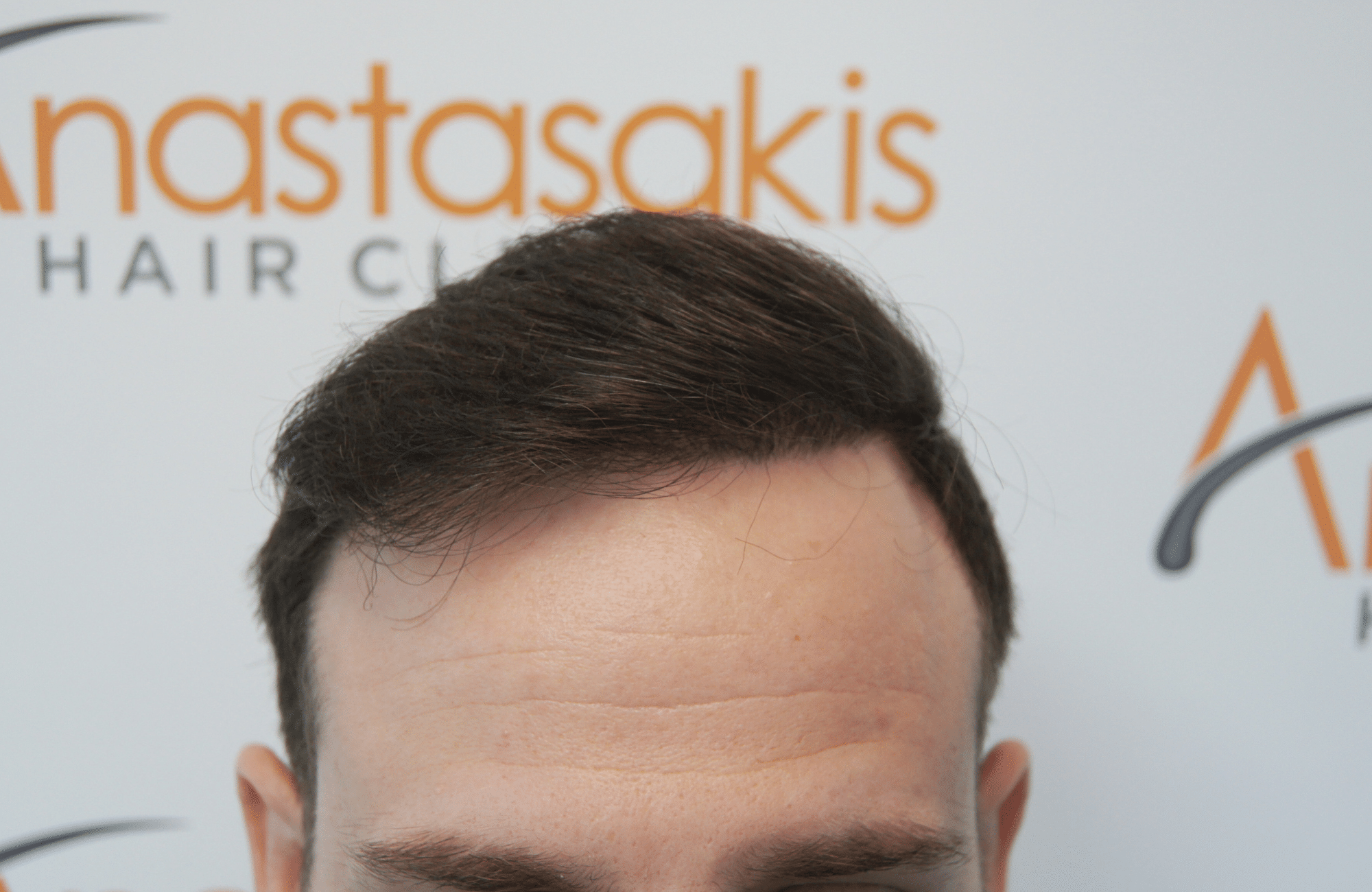 peristatiko piknosis meta ti metamosxefsi mallion me 2500 fus hairline