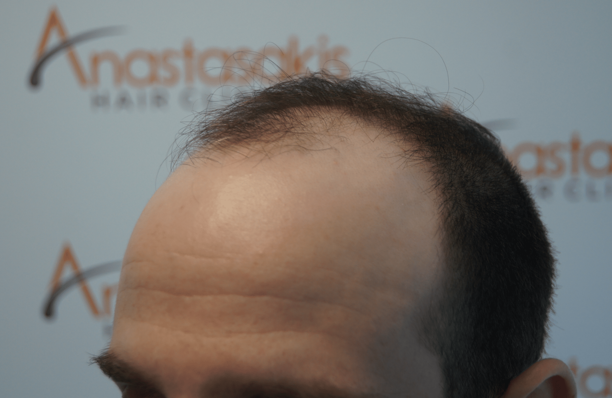 peristatiko piknosis prin ti metamosxefsi mallion me 2500 fus side2