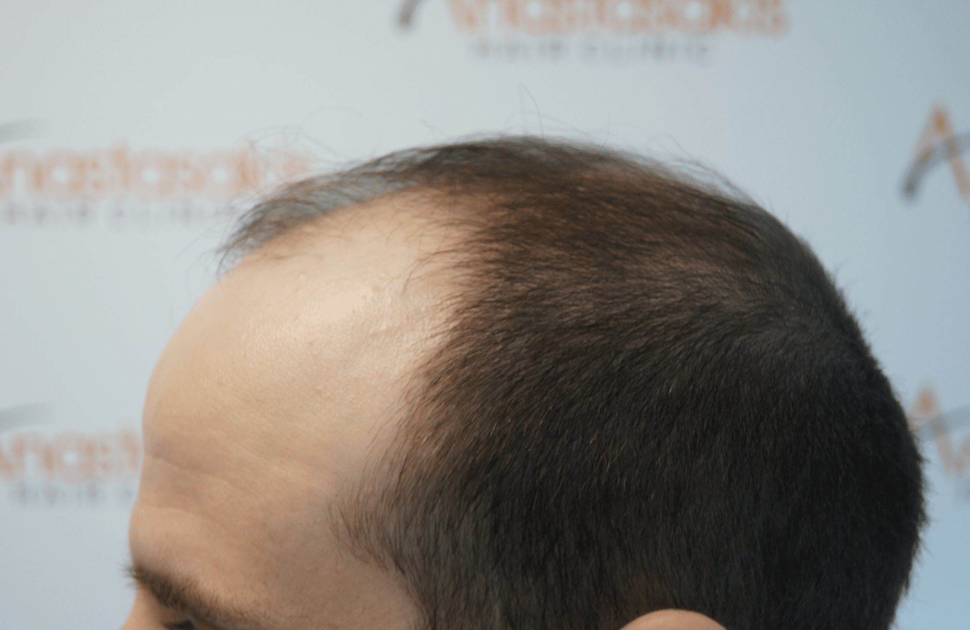 peristatiko piknosis prin ti metamosxefsi mallion me 2500 fus side3