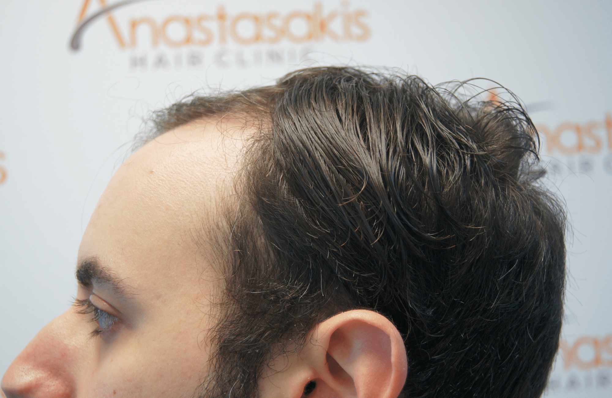 peristatiko prin ti metamosxefsi mallion me 2500 fus side3