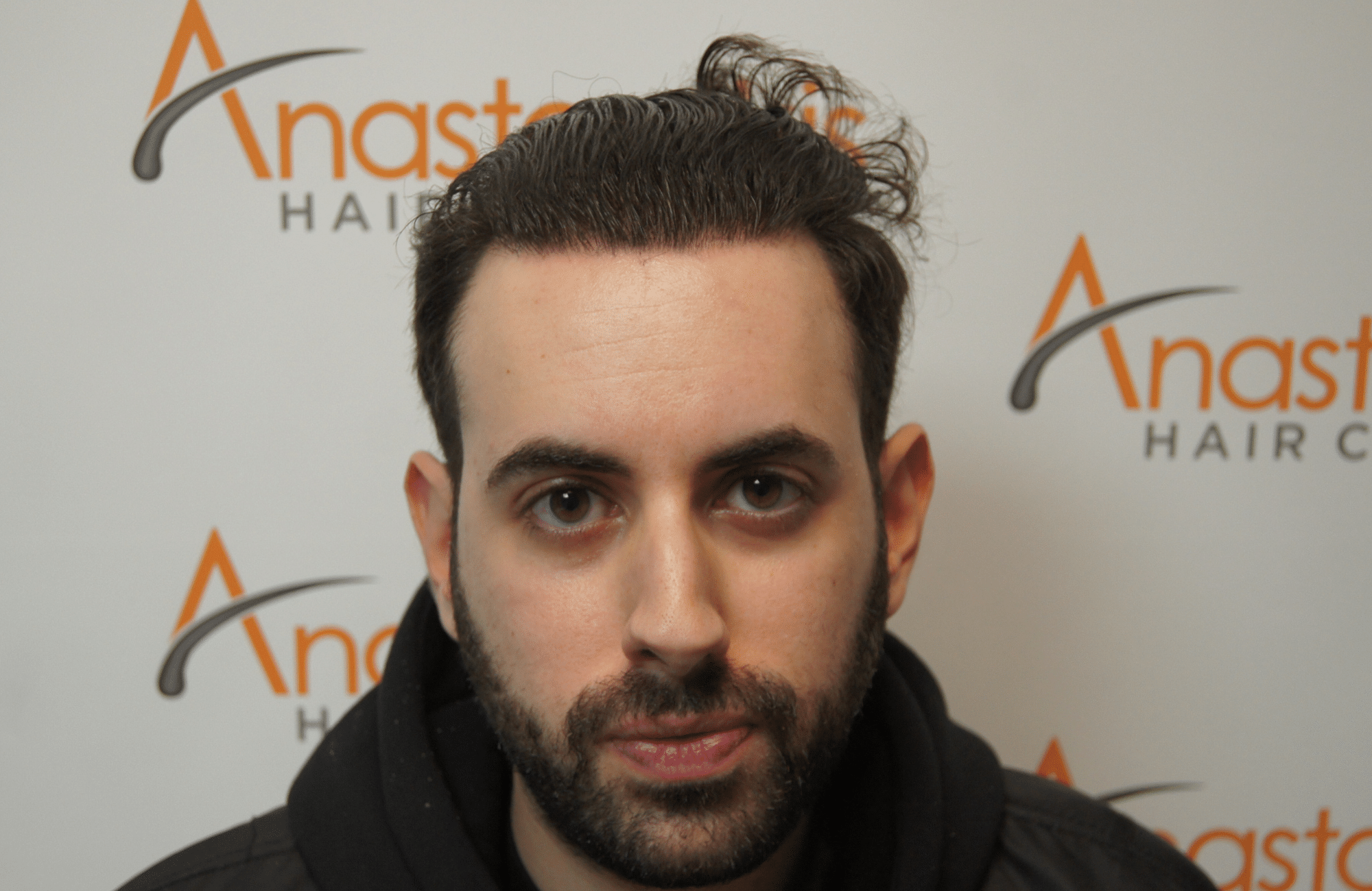 peristatiko meta ti metamosxefsi mallion me 2500 fus fullface wet hair