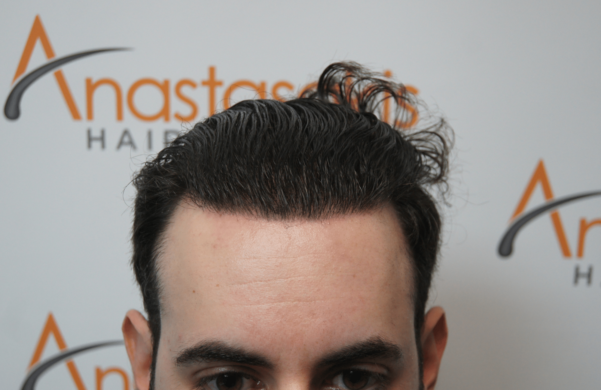 peristatiko meta ti metamosxefsi mallion me 2500 fus hairline wet hair