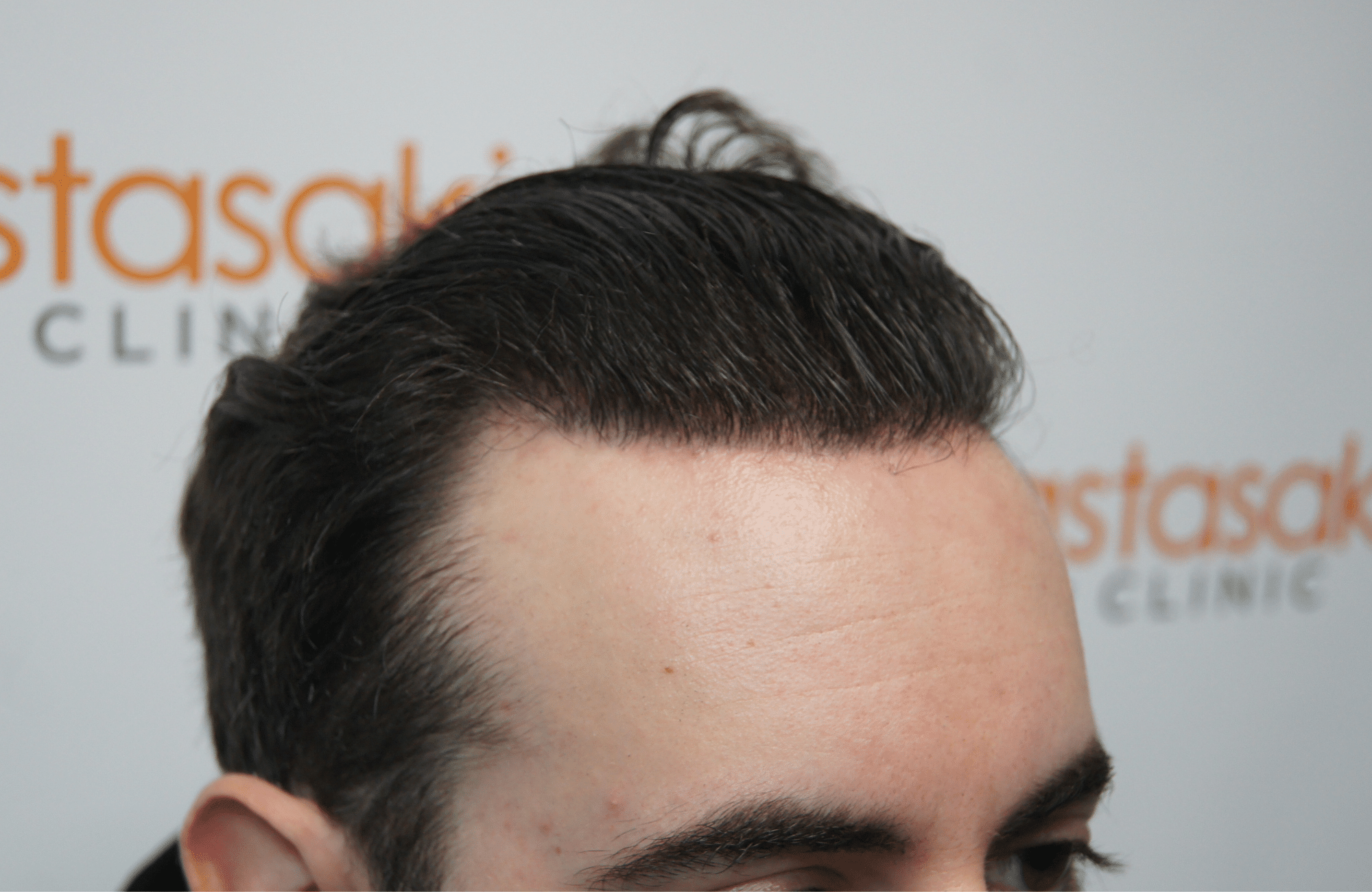 peristatiko meta ti metamosxefsi mallion me 2500 fus side wet hair