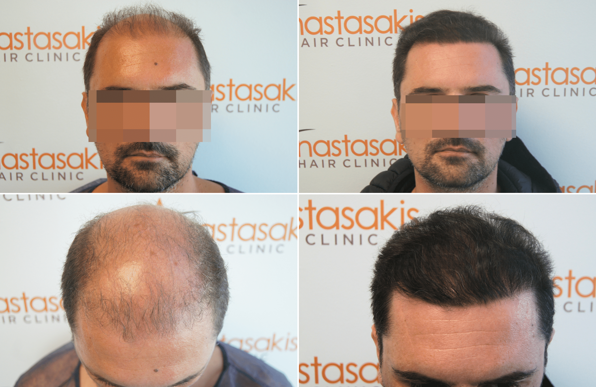 https://anastasakishairclinic.com/portfolio/apotelesma-metamosxefsis-mallion-anastasakis-hair-clinic-235/