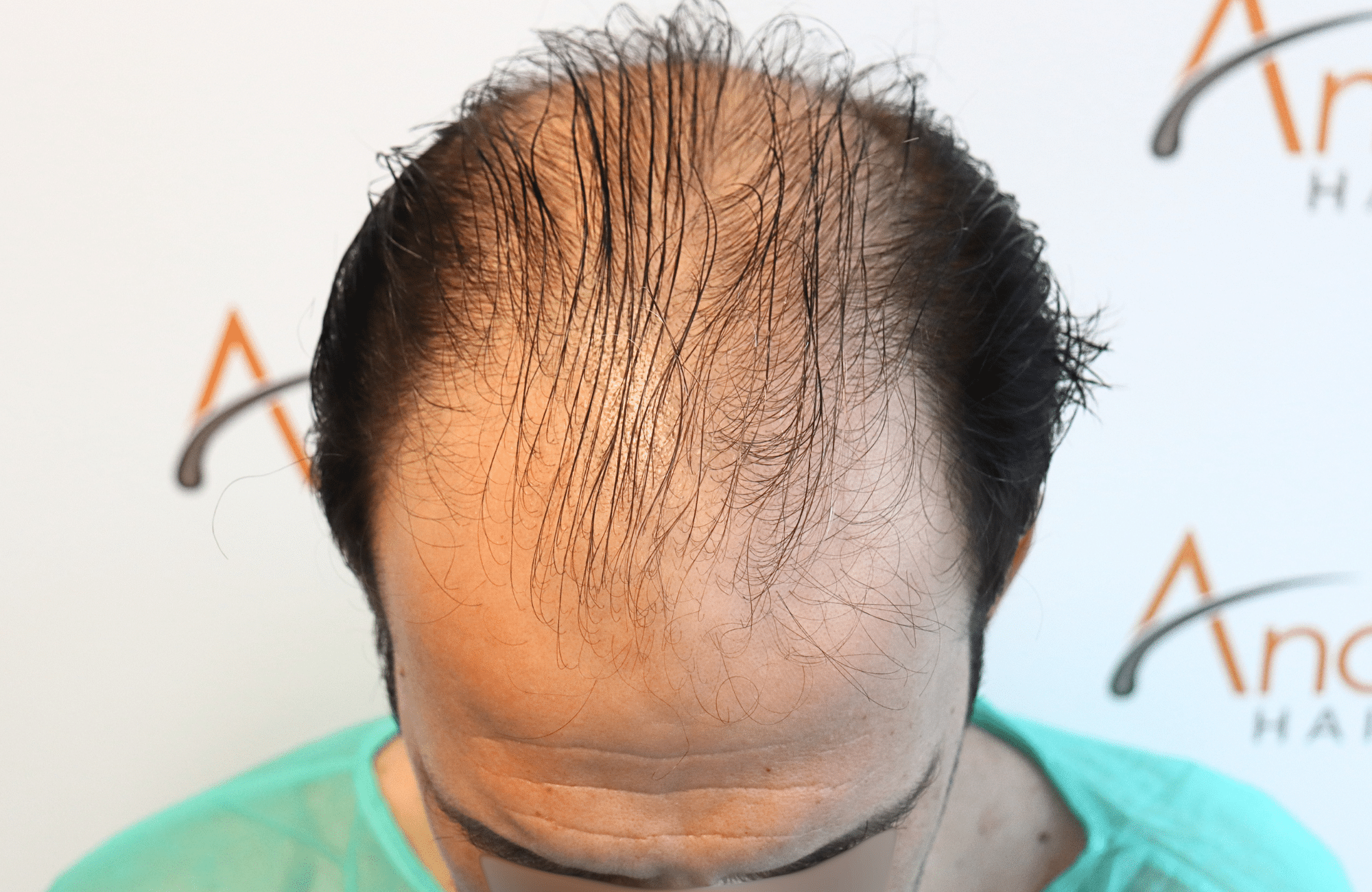 hair transplant 2600 fus thin 1st stage